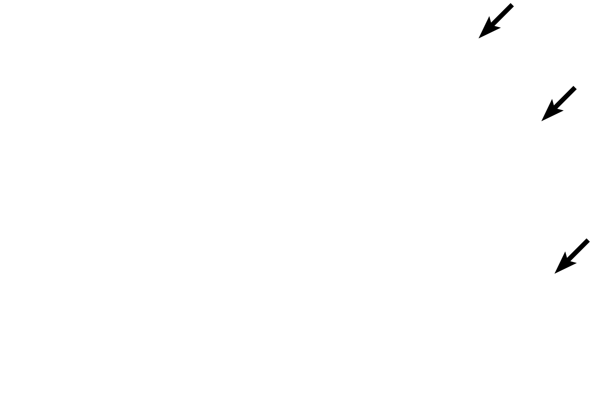 Sloughing nucleated cells <p>A thick stratified squamous nonkeratinized (moist) epithelium lines the esophagus, providing protection for the organ during food transport. Its moist surface, together with secretions from glands in the lamina propria and submucosa, provide lubrication. The epithelium is not keratinized and nucleated cells remain at the surface of this epithelium.  400x</p>
