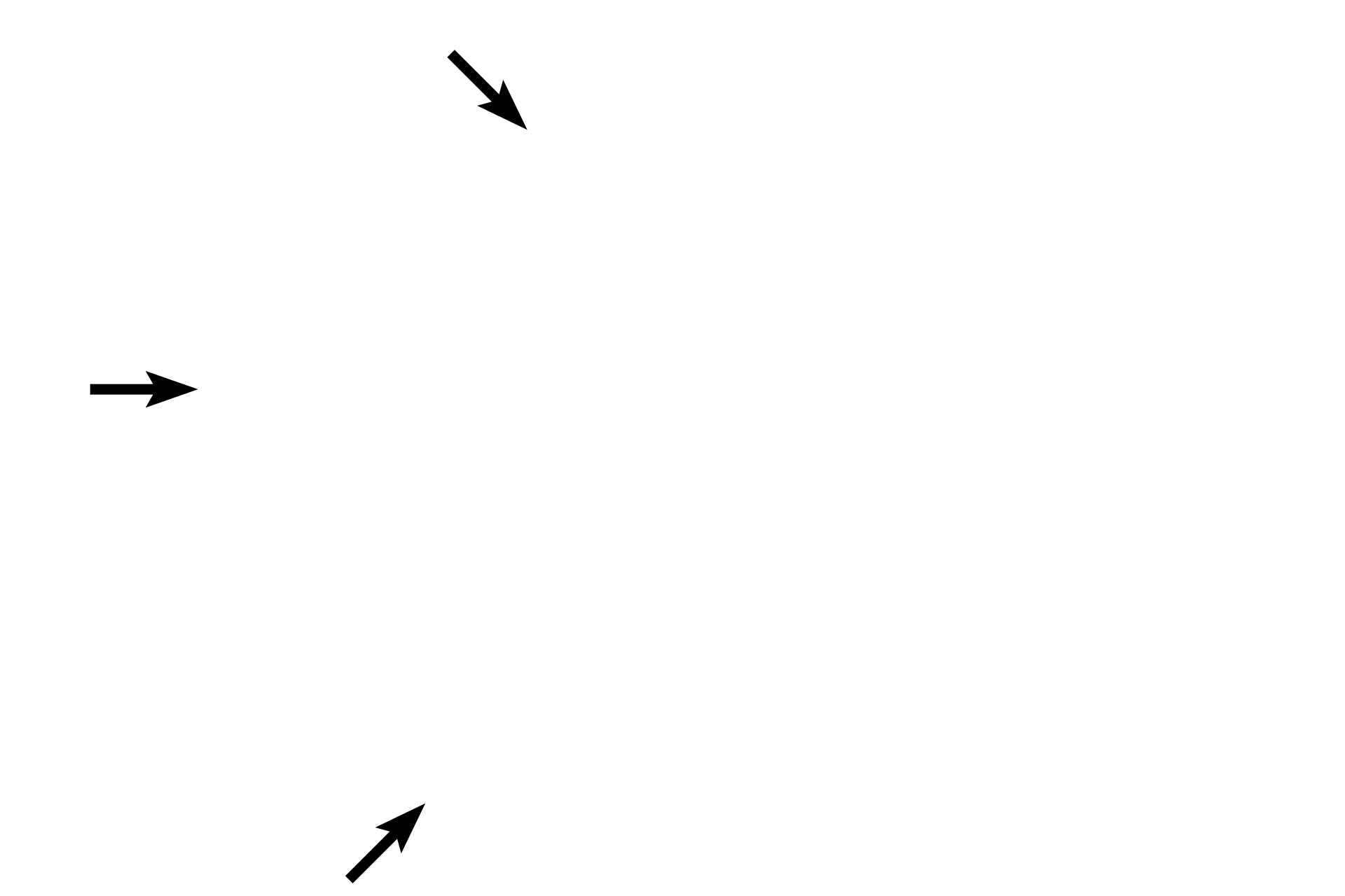 Capsule > <p>Each lymph node is surrounded by a dense connective tissue capsule.  Afferent lymphatics pierce the capsule to enter the subcapsular sinus lying beneath it.  The subcapsular sinus drains into trabecular (intermediate) sinuses that traverse the cortex to connect with medullary sinuses.  Medullary sinuses anastomose to form the efferent lymphatic that exits at the hilum.</p>

