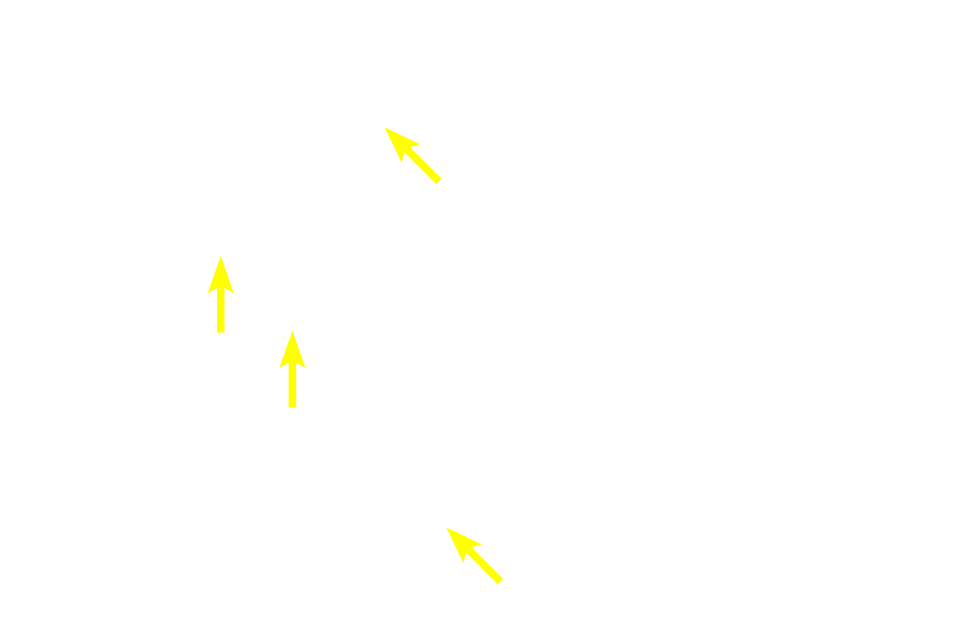 Trabecular sinuses <p>Each lymph node is surrounded by a dense connective tissue capsule.  Afferent lymphatics pierce the capsule to enter the subcapsular sinus lying beneath it.  The subcapsular sinus drains into trabecular (intermediate) sinuses that traverse the cortex to connect with medullary sinuses.  Medullary sinuses anastomose to form the efferent lymphatic that exits at the hilum.</p>
