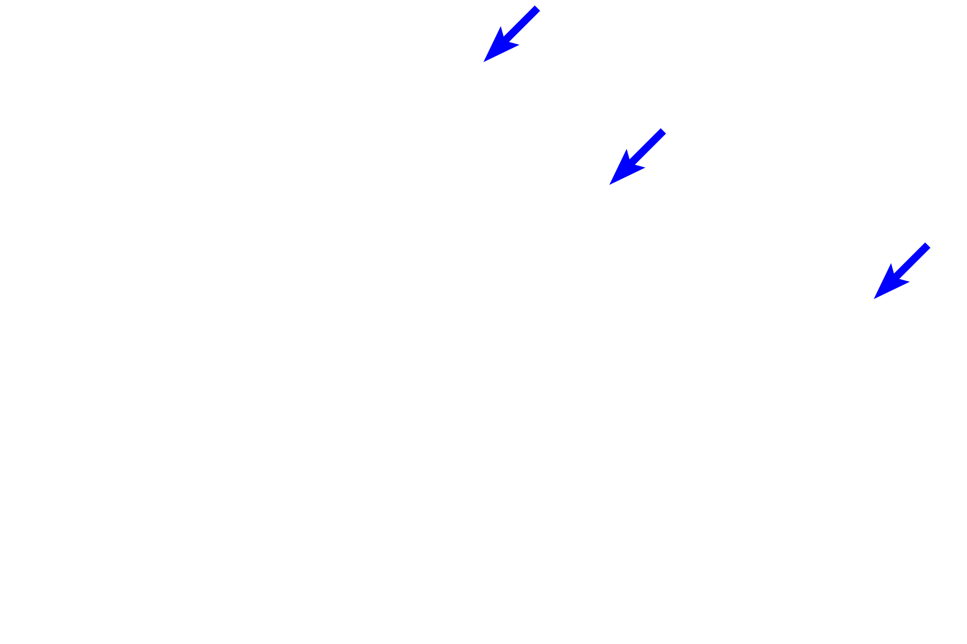 Capsule <p>The outer cortex of a lymph node is filled with B-dependent lymphoid nodules and lies just beneath the capsule and the subcapsular sinus.  A portion of two trabecular sinuses are also present, but these sinuses are difficult to appreciate as they are filled with cells.  100x</p>
