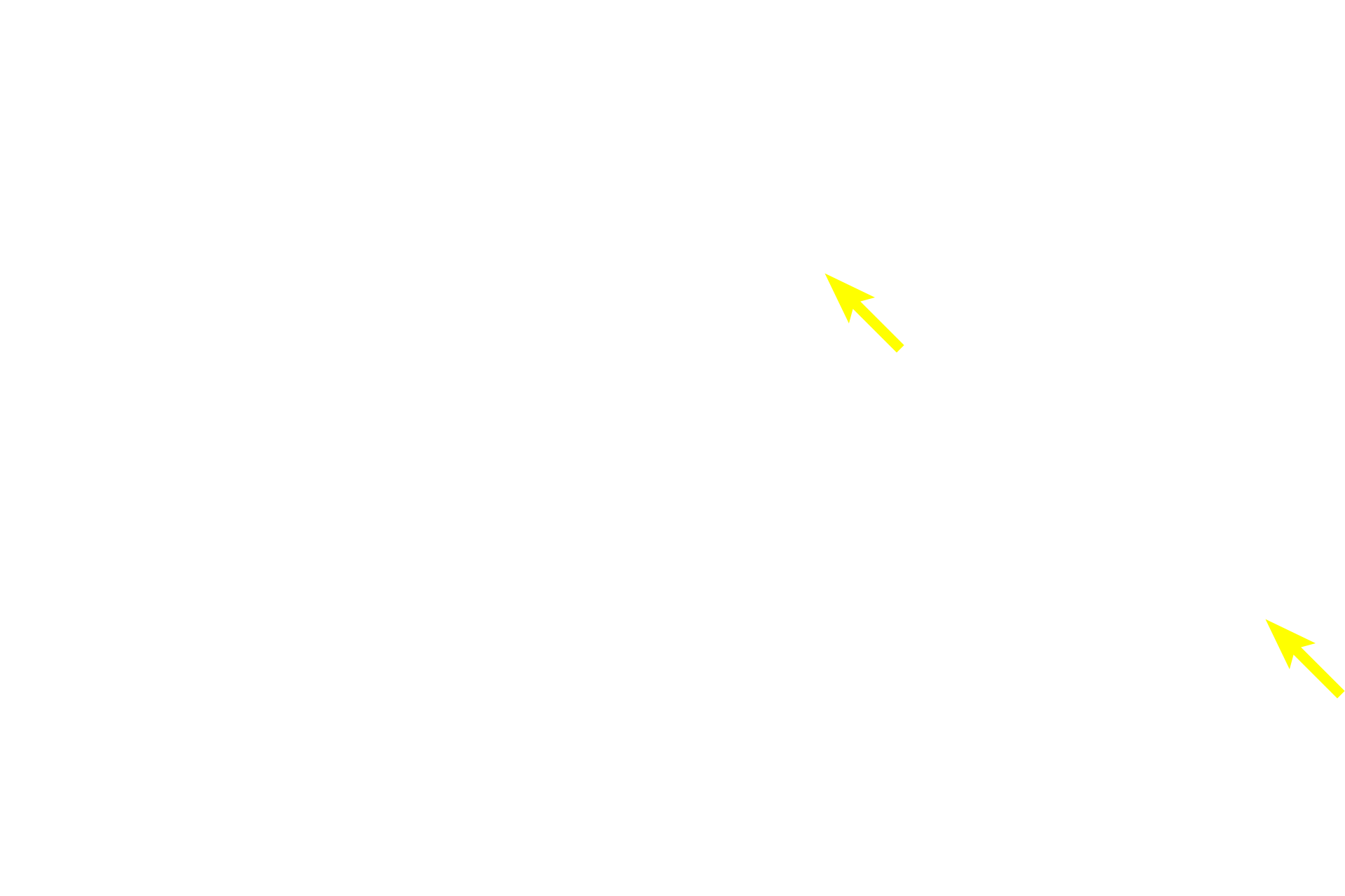 Subcapsular sinus <p>The outer cortex of a lymph node is filled with B-dependent lymphoid nodules and lies just beneath the capsule and the subcapsular sinus.  A portion of two trabecular sinuses are also present, but these sinuses are difficult to appreciate as they are filled with cells.  100x</p>
