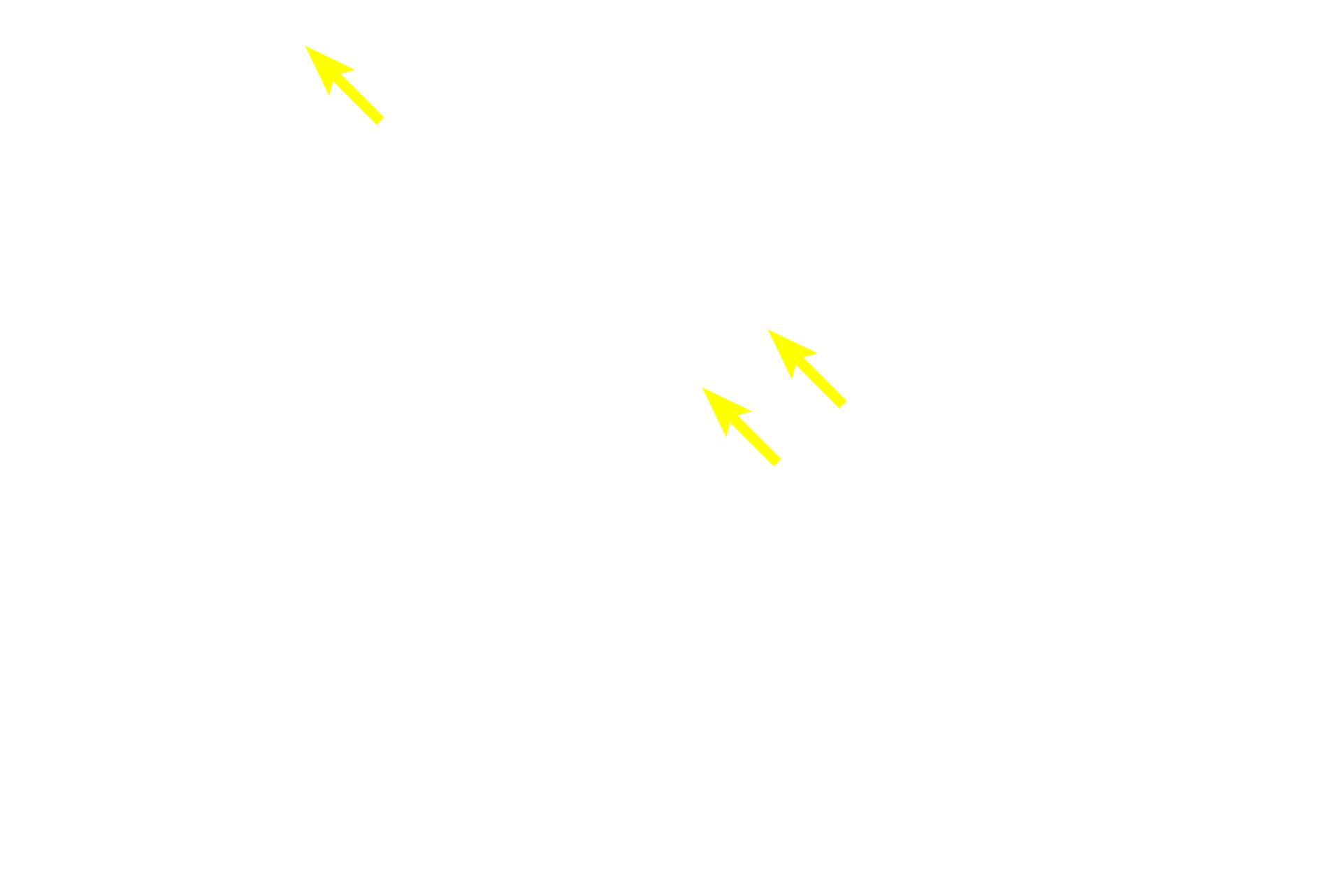 Trabecular sinuses <p>The outer cortex of a lymph node is filled with B-dependent lymphoid nodules and lies just beneath the capsule and the subcapsular sinus.  A portion of two trabecular sinuses are also present, but these sinuses are difficult to appreciate as they are filled with cells.  100x</p>
