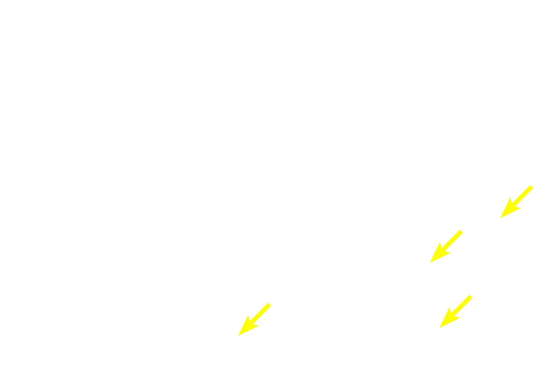 Medullary cords <p>Afferent lymph vessels penetrate the node at its convex surface, where lymph enters the subcapsular sinus.  From there, lymph percolates through trabecular (intermediate) sinuses adjacent to trabeculae, and into medullary sinuses.  Any foreign matter carried in the lymph is exposed to and processed by macrophages occupying these sinuses.</p>
