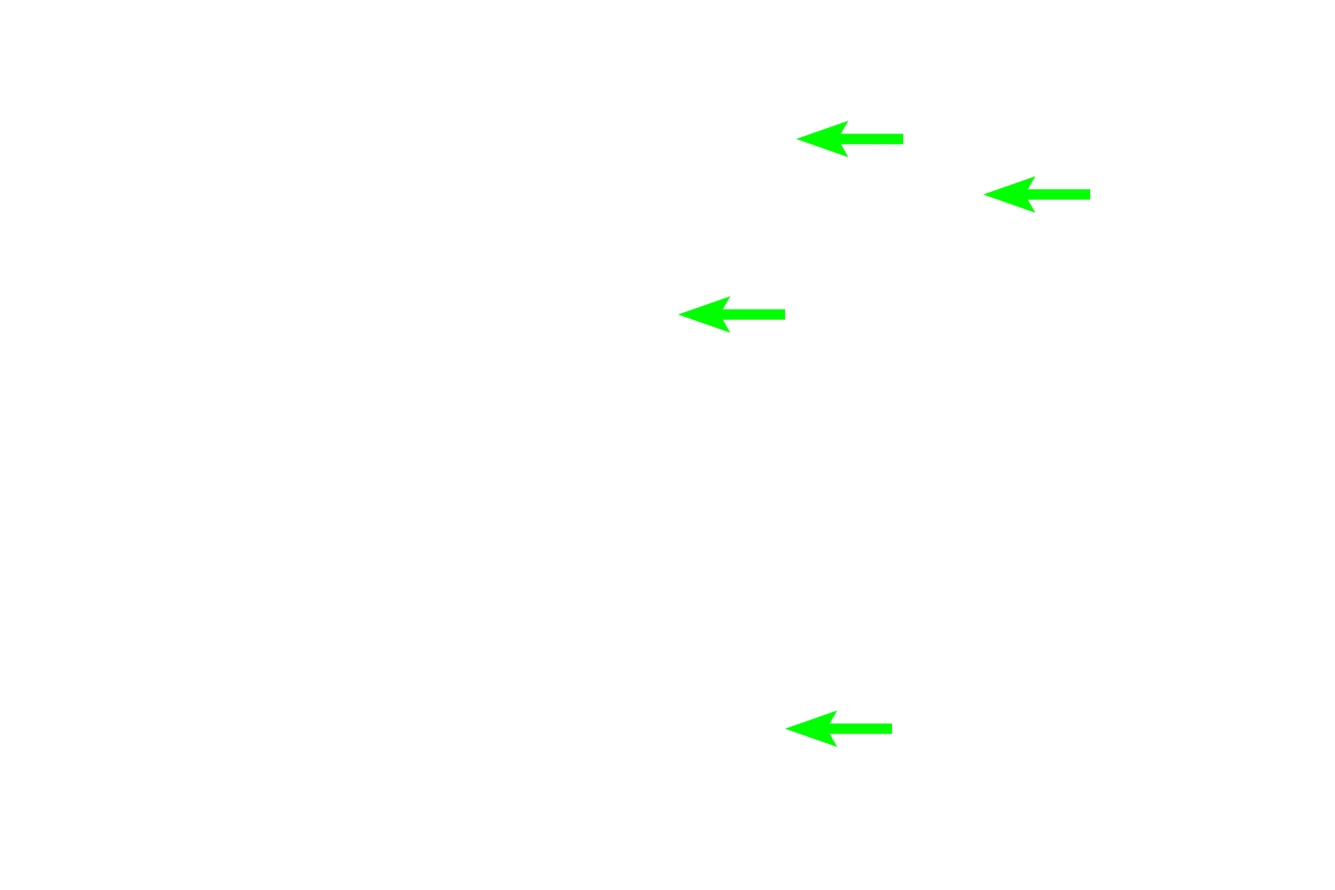 Red blood cells in stroma > <p>Blood carried by sheathed capillaries “bleeds” directly into the stroma of the cord.  Thus, blood cells are not contained within vessels, and red blood cells can be phagocytosed by macrophages.  Blood carried by unsheathed capillaries passes into the sinus, where it is also surveyed by macrophages that span the lumen.</p>
