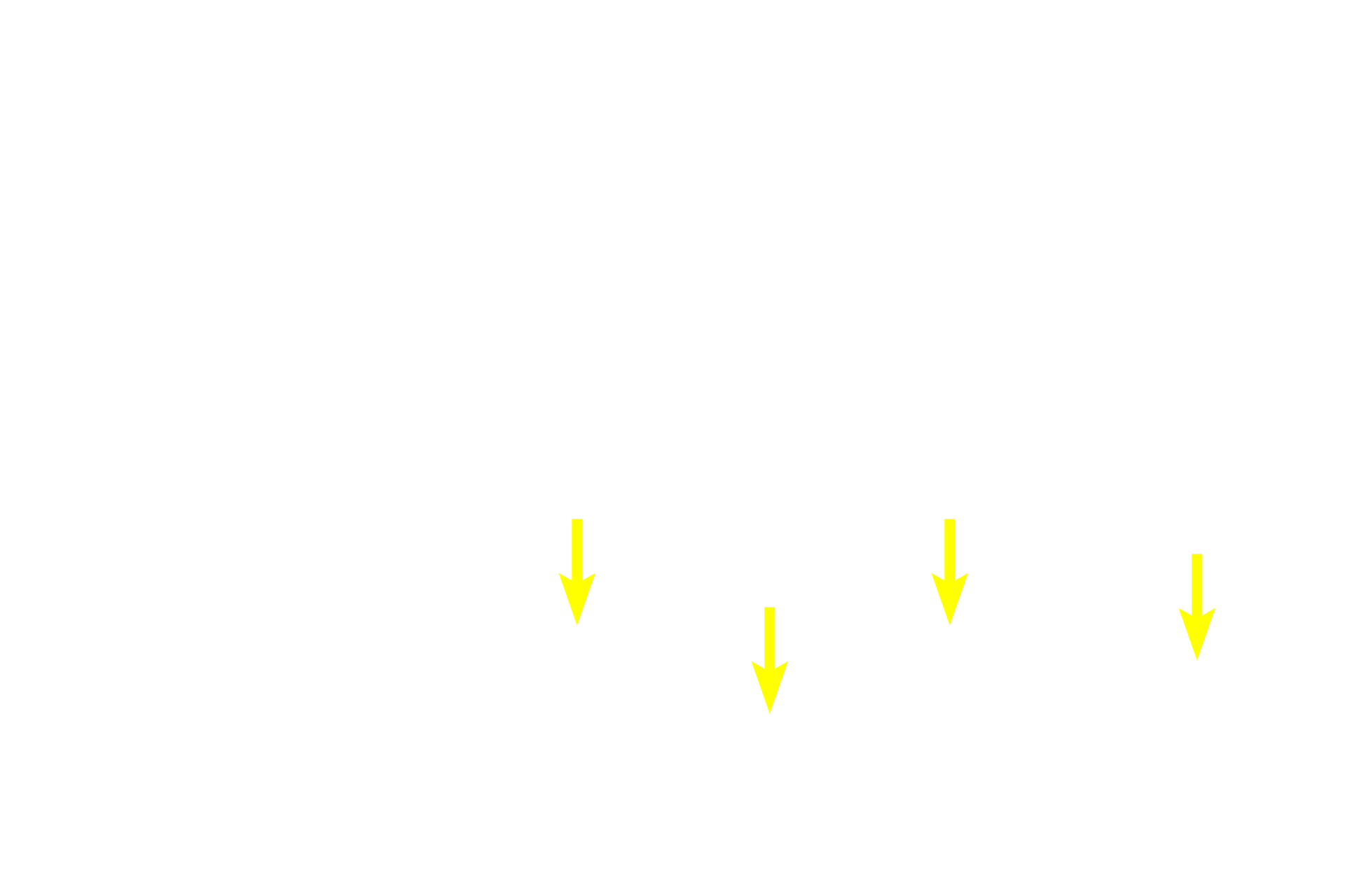 Diffuse lymphoid tissue <p>This Peyer’s patch demonstrates the accumulation of lymphoid tissues in the ileum.  Although secondary nodules are usually characteristic of Peyer’s patches, none are seen here.  However, primary nodules and diffuse lymphoid tissue are prevalent.  Because Peyer’s patches are located in the lamina propria of the mucosa, they are part of MALT and filter tissue fluid.  200x</p>
