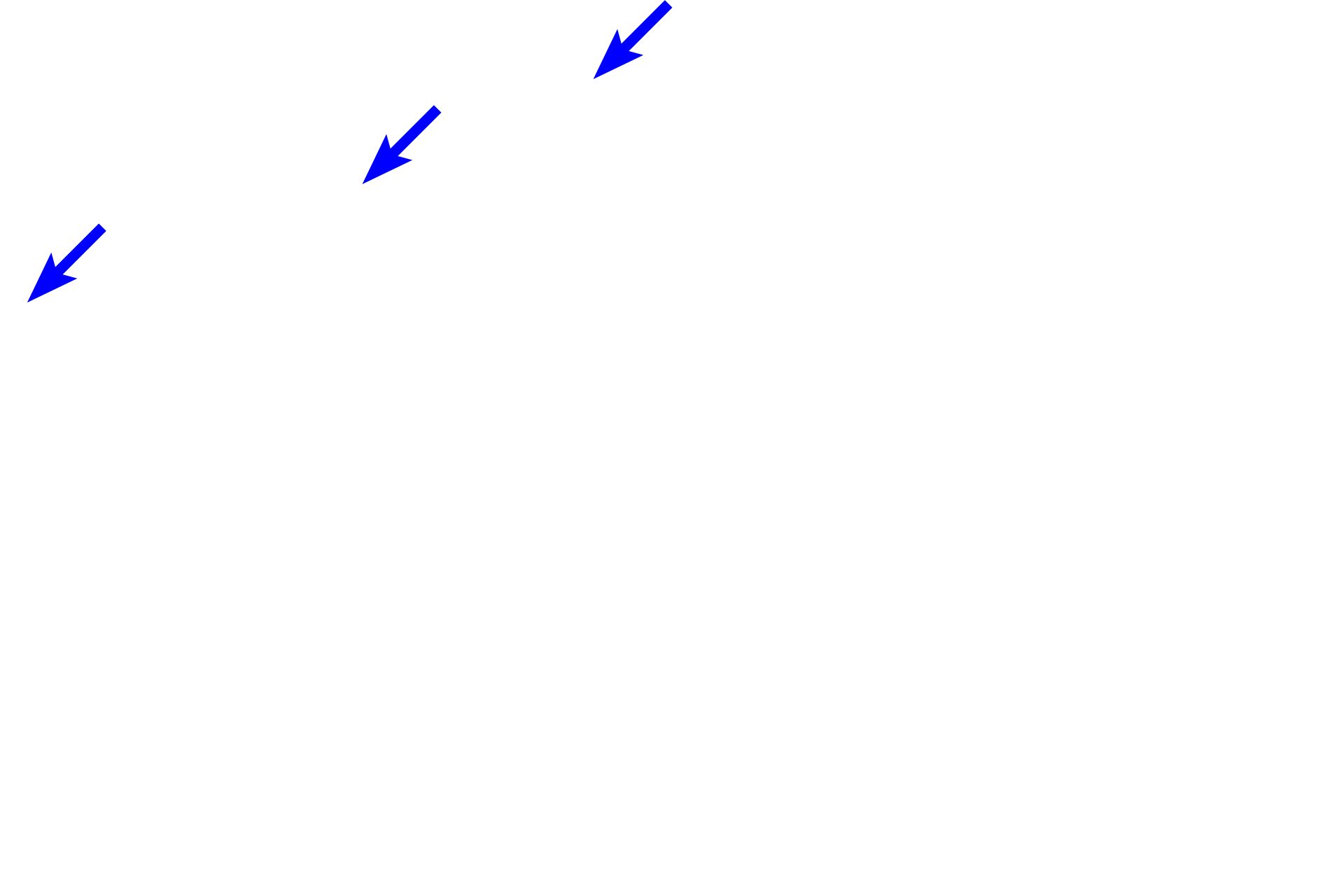 Lumen of ileum <p>This Peyer’s patch demonstrates the accumulation of lymphoid tissues in the ileum.  Although secondary nodules are usually characteristic of Peyer’s patches, none are seen here.  However, primary nodules and diffuse lymphoid tissue are prevalent.  Because Peyer’s patches are located in the lamina propria of the mucosa, they are part of MALT and filter tissue fluid.  200x</p>
