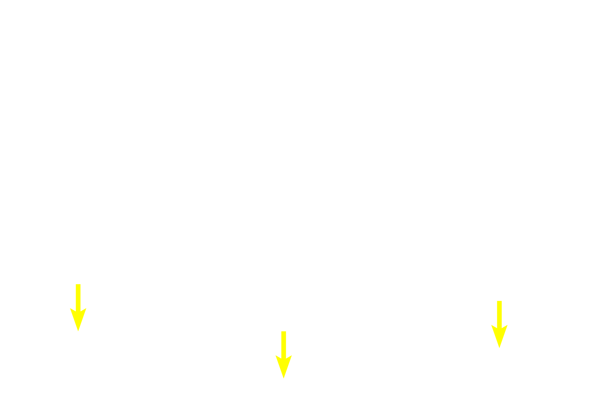Submucosa <p>This Peyer’s patch demonstrates the accumulation of lymphoid tissues in the ileum.  Although secondary nodules are usually characteristic of Peyer’s patches, none are seen here.  However, primary nodules and diffuse lymphoid tissue are prevalent.  Because Peyer’s patches are located in the lamina propria of the mucosa, they are part of MALT and filter tissue fluid.  200x</p>
