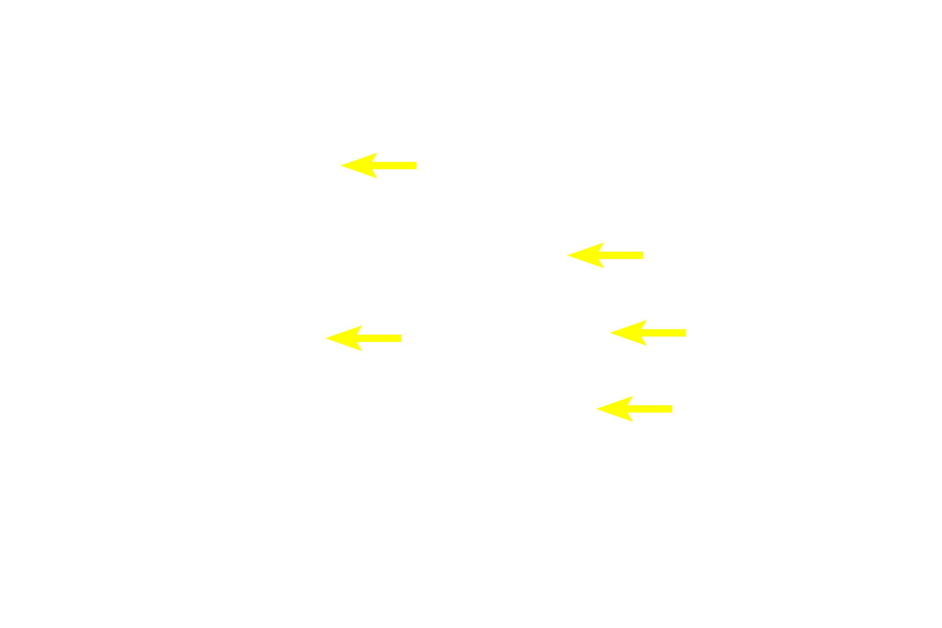 Lymphoid nodules <p>Tonsils form a ring of lymphoid tissue in the lamina propria around oral and nasal pharynges.  This palatine tonsil is covered by the stratified squamous epithelium of the oropharynx that invaginates into the tonsil, forming multiple crypts.  A partial capsule of dense connective tissue separates the tonsil from underlying connective tissue.  10x</p>
