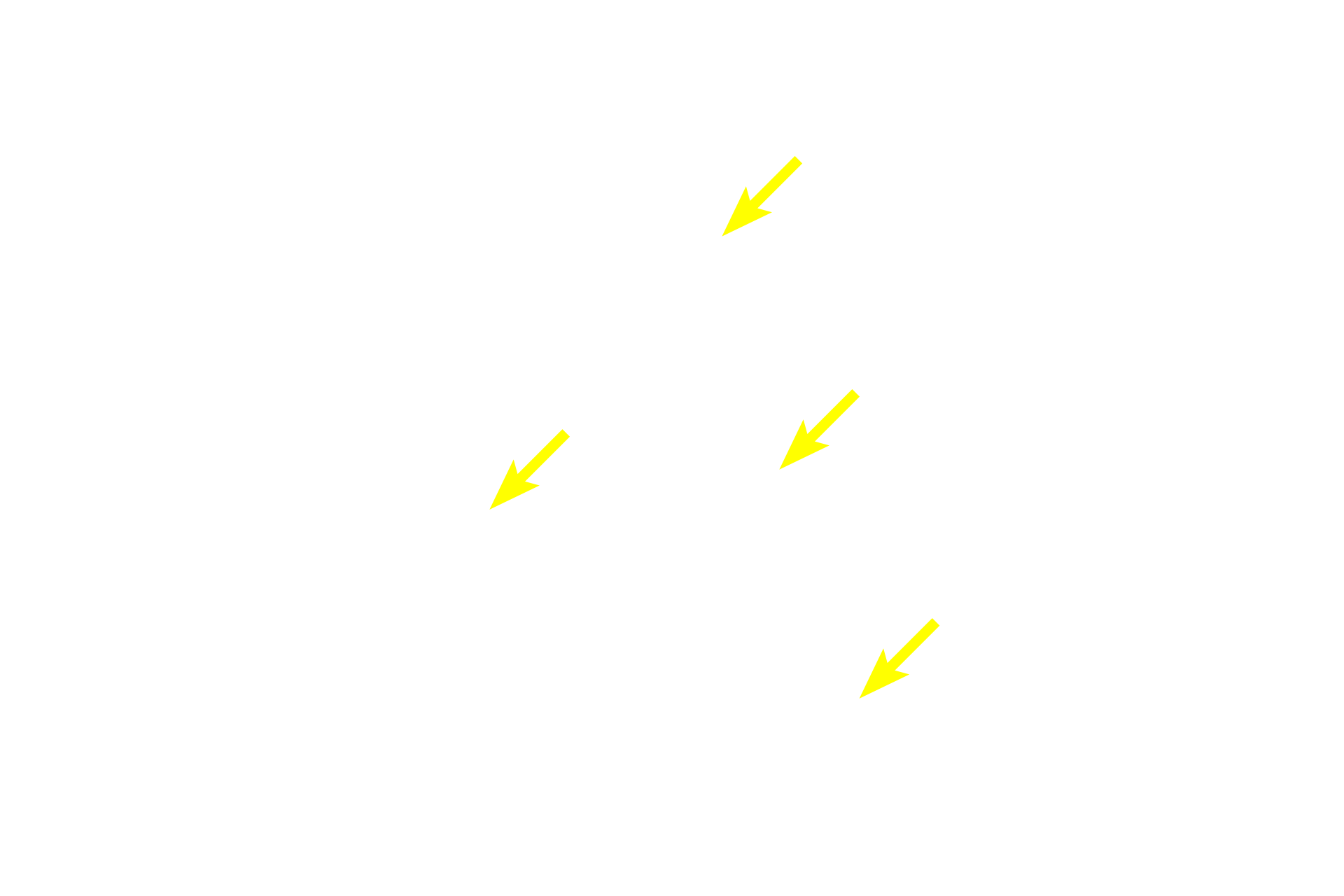 Diffuse lymphoid tissue <p>Tonsils form a ring of lymphoid tissue in the lamina propria around oral and nasal pharynges.  This palatine tonsil is covered by the stratified squamous epithelium of the oropharynx that invaginates into the tonsil, forming multiple crypts.  A partial capsule of dense connective tissue separates the tonsil from underlying connective tissue.  10x</p>
