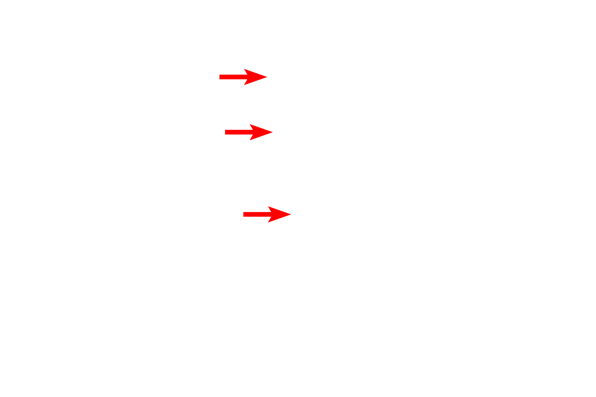 Crypt <p>The palatine tonsil, located in lamina propria of the oropharynx, is composed of lymphoid nodules embedded in diffuse lymphoid tissue. This section of tonsil is located beneath the epithelium of a pharyngeal crypt and is partially encapsulated by dense connective tissue, separating it from the underlying connective tissue. Because tonsils are located in the lamina propria, they are part of MALT and filter tissue fluid.  100x</p>
