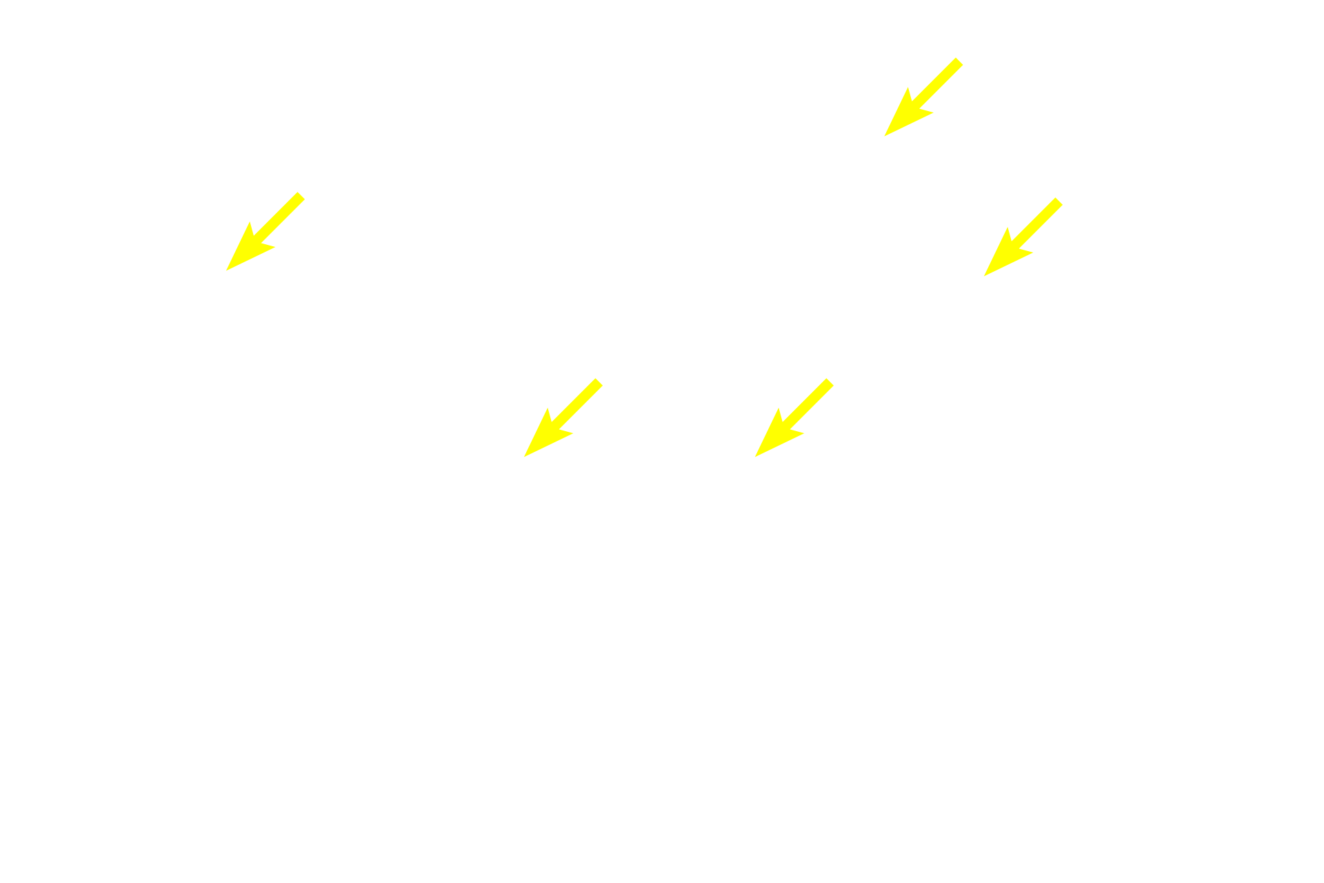 Diffuse lymphoid tissue <p>The palatine tonsil, located in lamina propria of the oropharynx, is composed of lymphoid nodules embedded in diffuse lymphoid tissue. This section of tonsil is located beneath the epithelium of a pharyngeal crypt and is partially encapsulated by dense connective tissue, separating it from the underlying connective tissue. Because tonsils are located in the lamina propria, they are part of MALT and filter tissue fluid.  100x</p>
