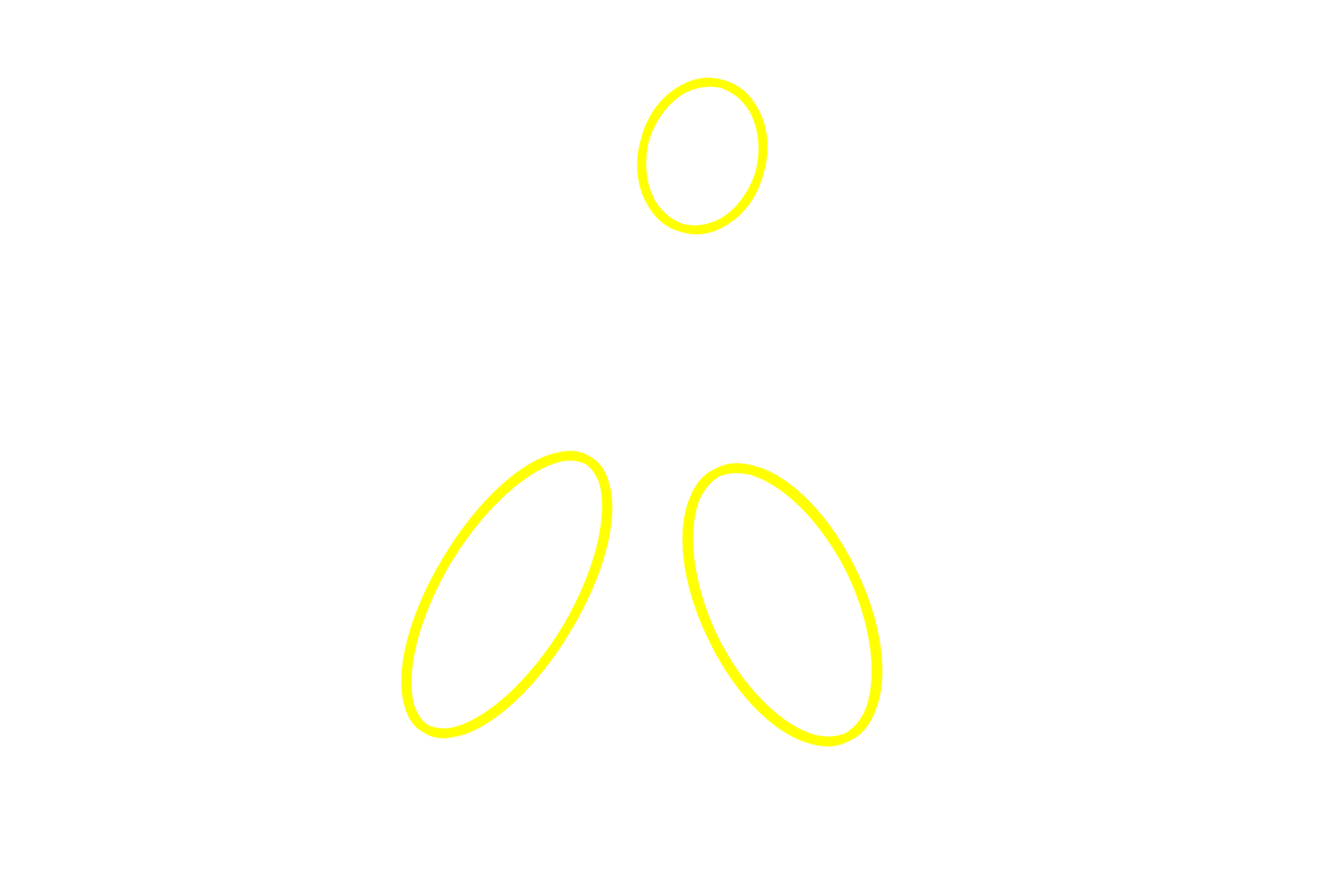 Secondary nodules <p>The palatine tonsil, located in lamina propria of the oropharynx, is composed of lymphoid nodules embedded in diffuse lymphoid tissue. This section of tonsil is located beneath the epithelium of a pharyngeal crypt and is partially encapsulated by dense connective tissue, separating it from the underlying connective tissue. Because tonsils are located in the lamina propria, they are part of MALT and filter tissue fluid.  100x</p>
