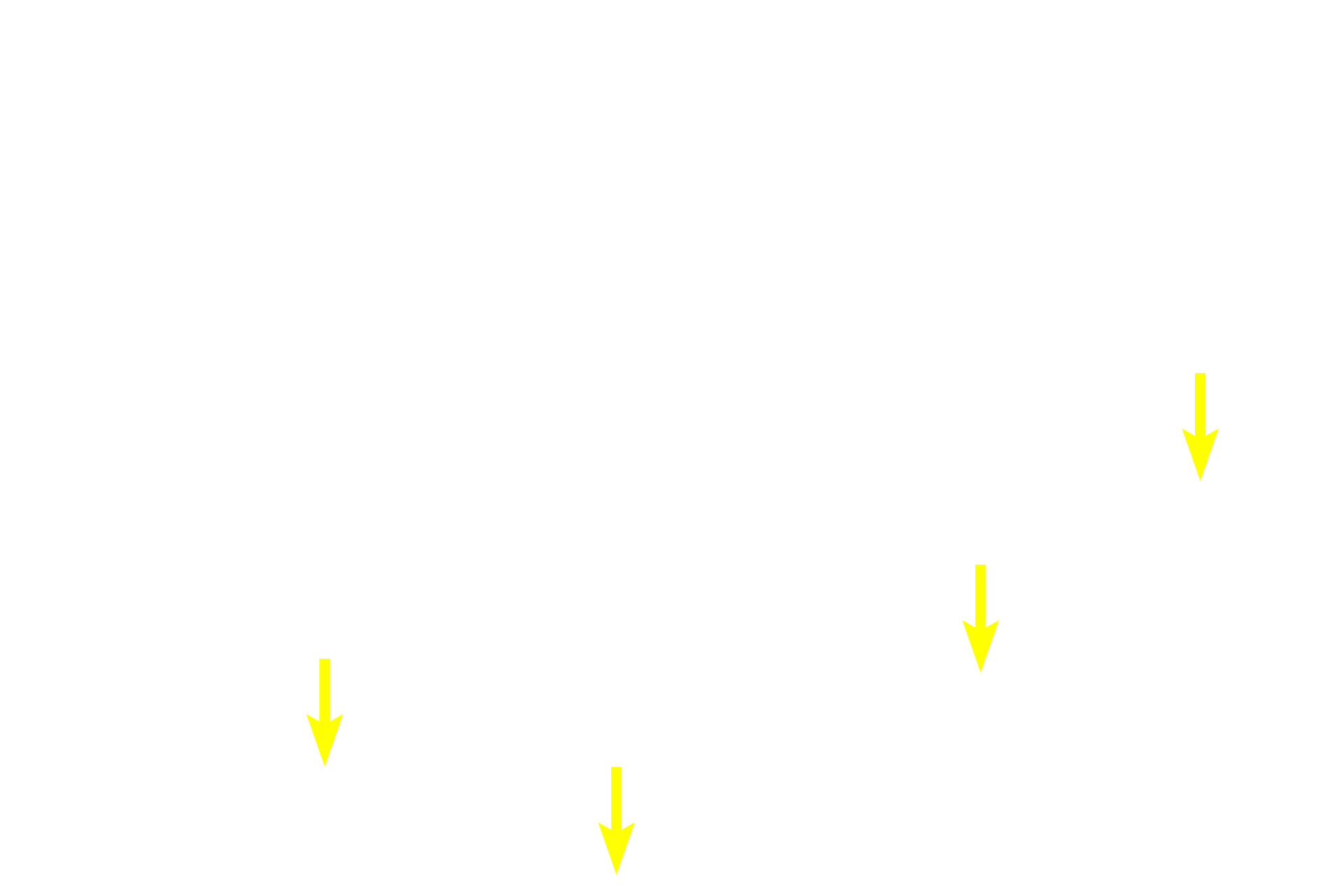 Connective tissue capsule <p>The palatine tonsil, located in lamina propria of the oropharynx, is composed of lymphoid nodules embedded in diffuse lymphoid tissue. This section of tonsil is located beneath the epithelium of a pharyngeal crypt and is partially encapsulated by dense connective tissue, separating it from the underlying connective tissue. Because tonsils are located in the lamina propria, they are part of MALT and filter tissue fluid.  100x</p>

