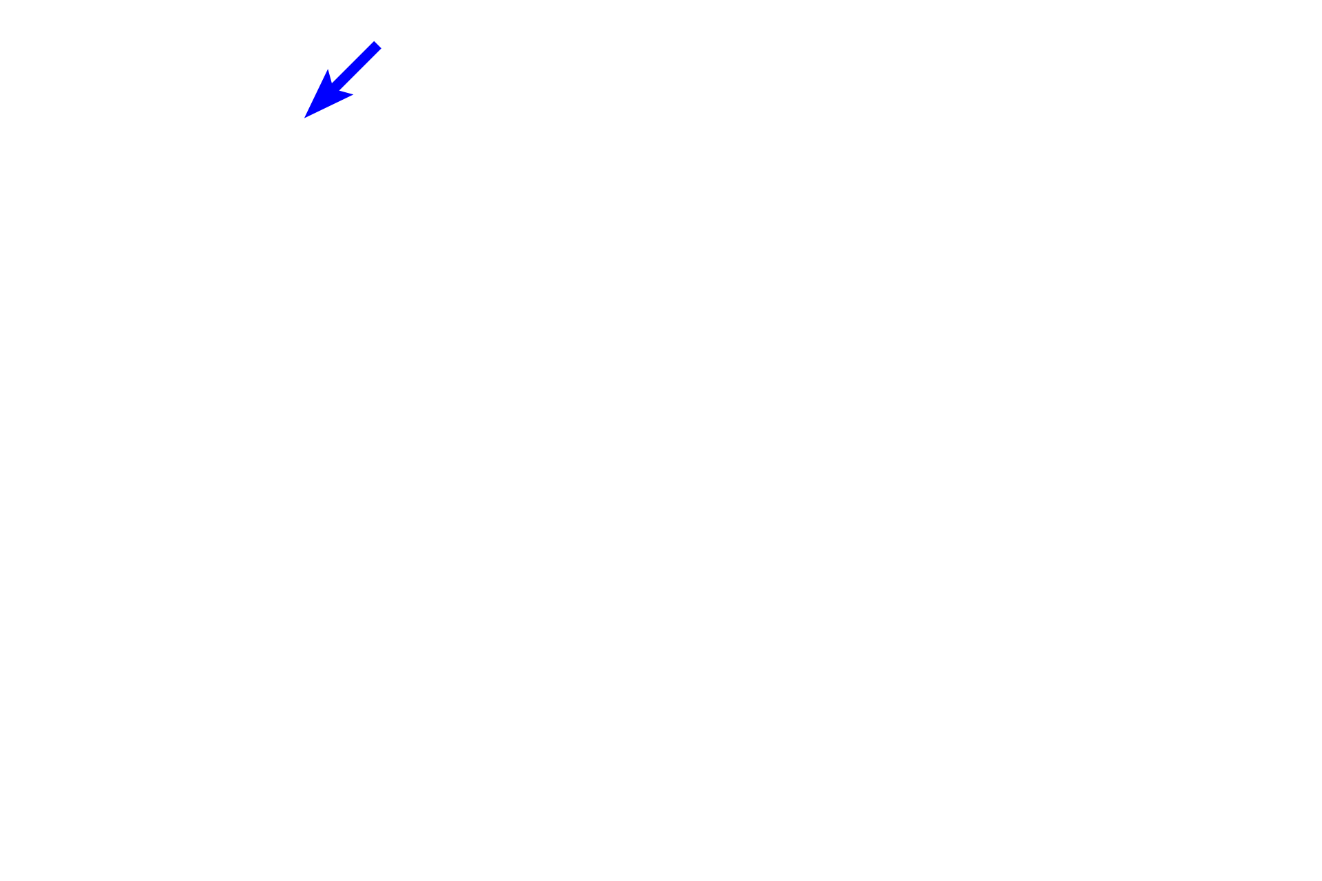  - Neutrophil <p>The pharyngeal tonsils are lined by respiratory epithelium, pseudostratified ciliated columnar. This epithelium is highly infiltrated with lymphocytes and other white blood cells, presenting a greatly altered appearance from the usual pharyngeal epithelium. Note the diffuse lymphoid tissue in the underlying lamina propria. 1000x</p>
