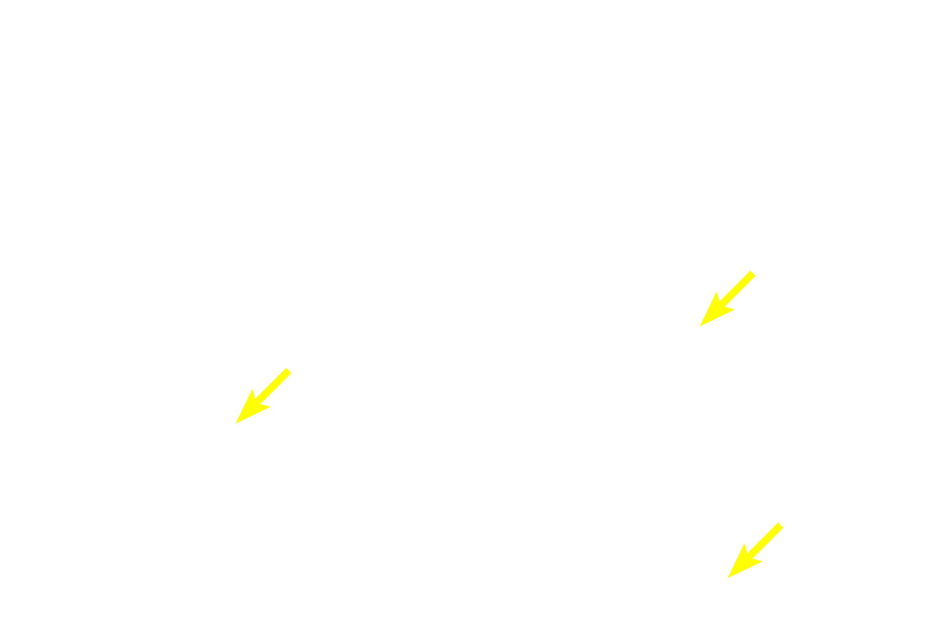  - Macrophages > <p>Macrophages (tingible body macrophages), with phagosomes in their cytoplasm, indicate the phagocytic activity occurring in the germinal center.  The term “tingible” refers to the fact that the phagocytosed material is stainable.</p>
