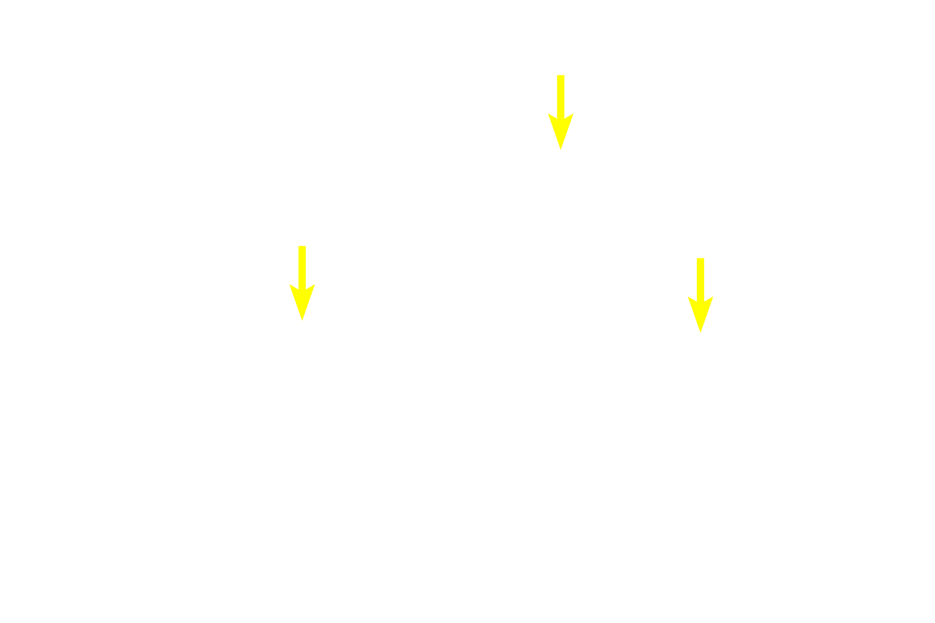 Diffuse lymphoid tissue <p>The appendix possesses both diffuse and nodular lymphoid tissue in the lamina propria.  The presence of germinal centers differentiates secondary from primary lymphoid nodules.  All these lymphoid tissues filter tissue fluid of the lamina propria.  40x</p>
