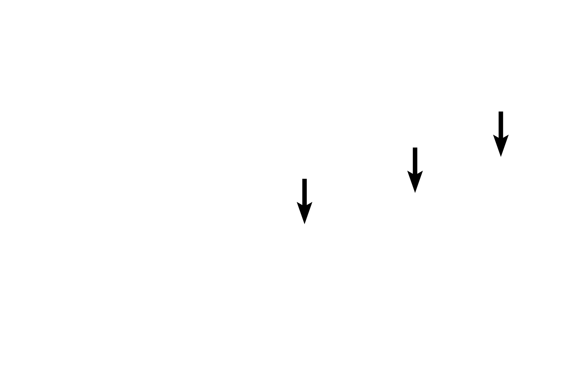  - Duct of Meibomium gland <p>This higher magnification image of a Meibomium gland (tarsal gland) shows its simple, branched acinar structure.  Each acinus empties into an unbranched duct that opens at the margin of the eyelid.  There are numerous Meibomium glands in each eyelid, with a larger number in the upper eyelid.  Meibomian glands secrete an oily material by the holocrine mode of secretion.</p>
