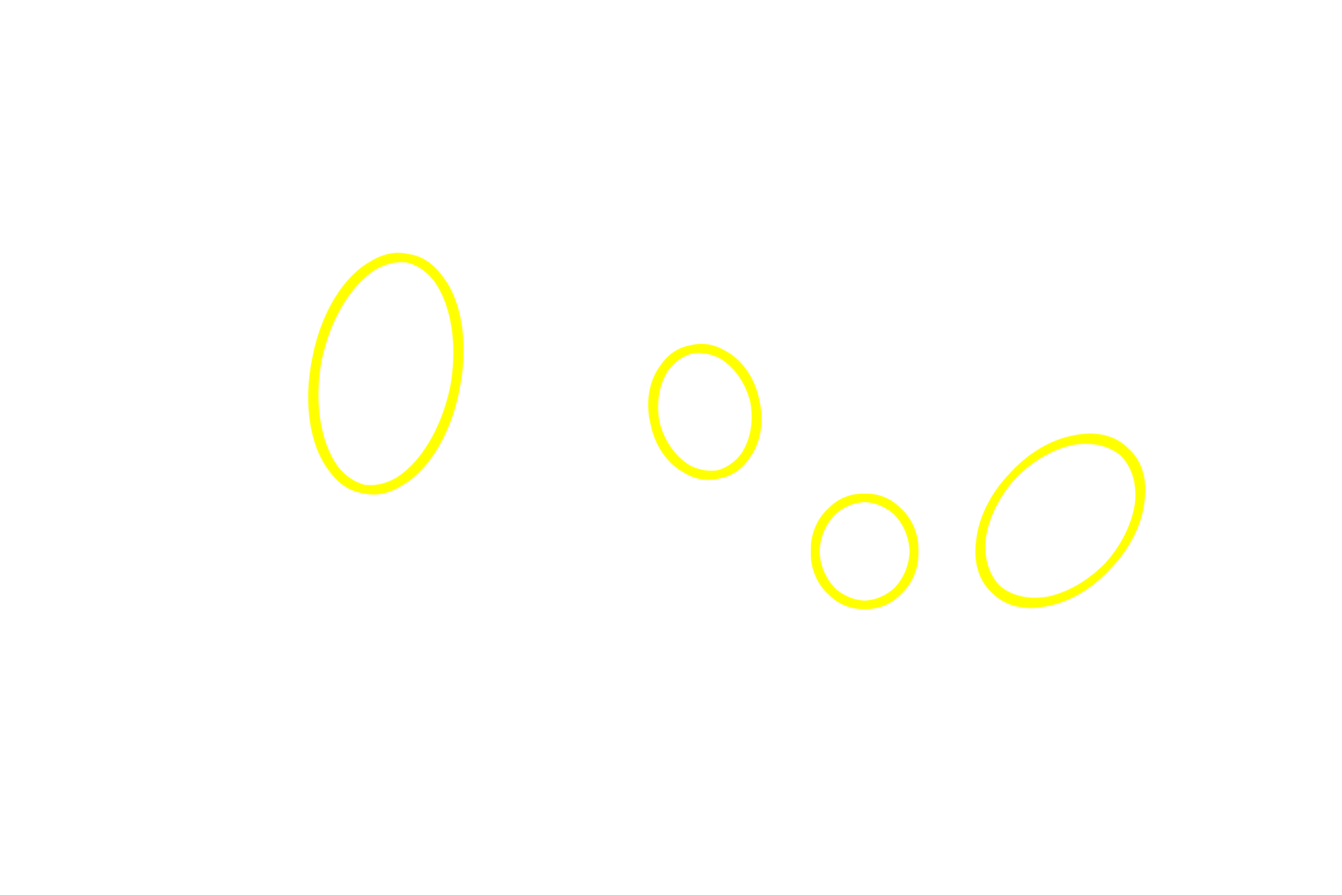  - Acini <p>This higher magnification image of a Meibomium gland (tarsal gland) shows its simple, branched acinar structure.  Each acinus empties into an unbranched duct that opens at the margin of the eyelid.  There are numerous Meibomium glands in each eyelid, with a larger number in the upper eyelid.  Meibomian glands secrete an oily material by the holocrine mode of secretion.</p>
