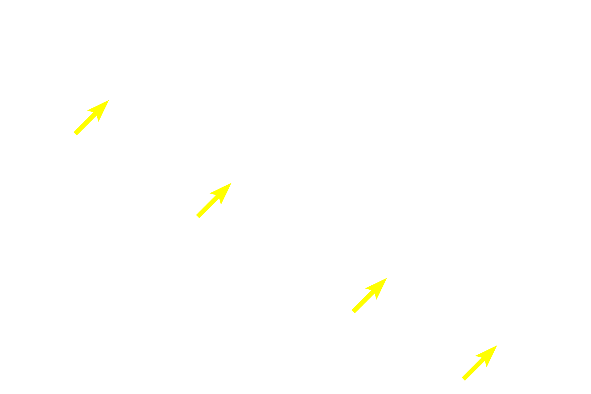 Choroid <p>This image shows the ora serrata at higher magnification.  Note how the multilayered, sensory retina (to the right) collapses into a single layer of cuboidal/columnar epithelium over the ciliary body.  The pigment epithelium of the retina continues forward and underlies the layer derived from the sensory retina.</p>
