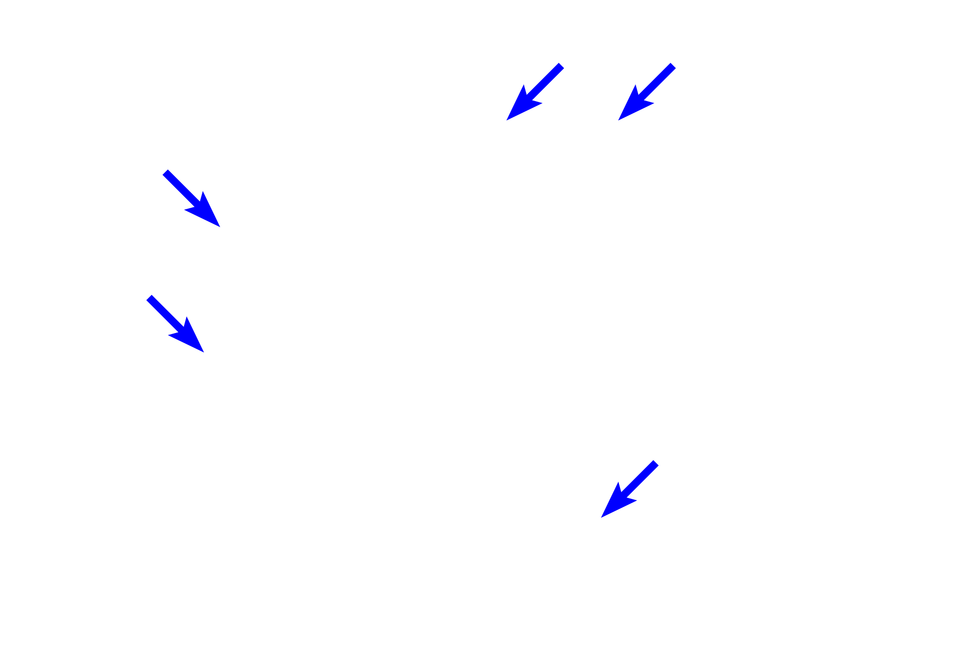  - Podocytes <p>The glomerular tuft of capillaries is surrounded by the visceral layer of Bowman’s capsule, whose modified cells form podocytes.  The parietal layer of Bowman’s capsule is composed of simple squamous epithelium.  10x, 400x</p>
