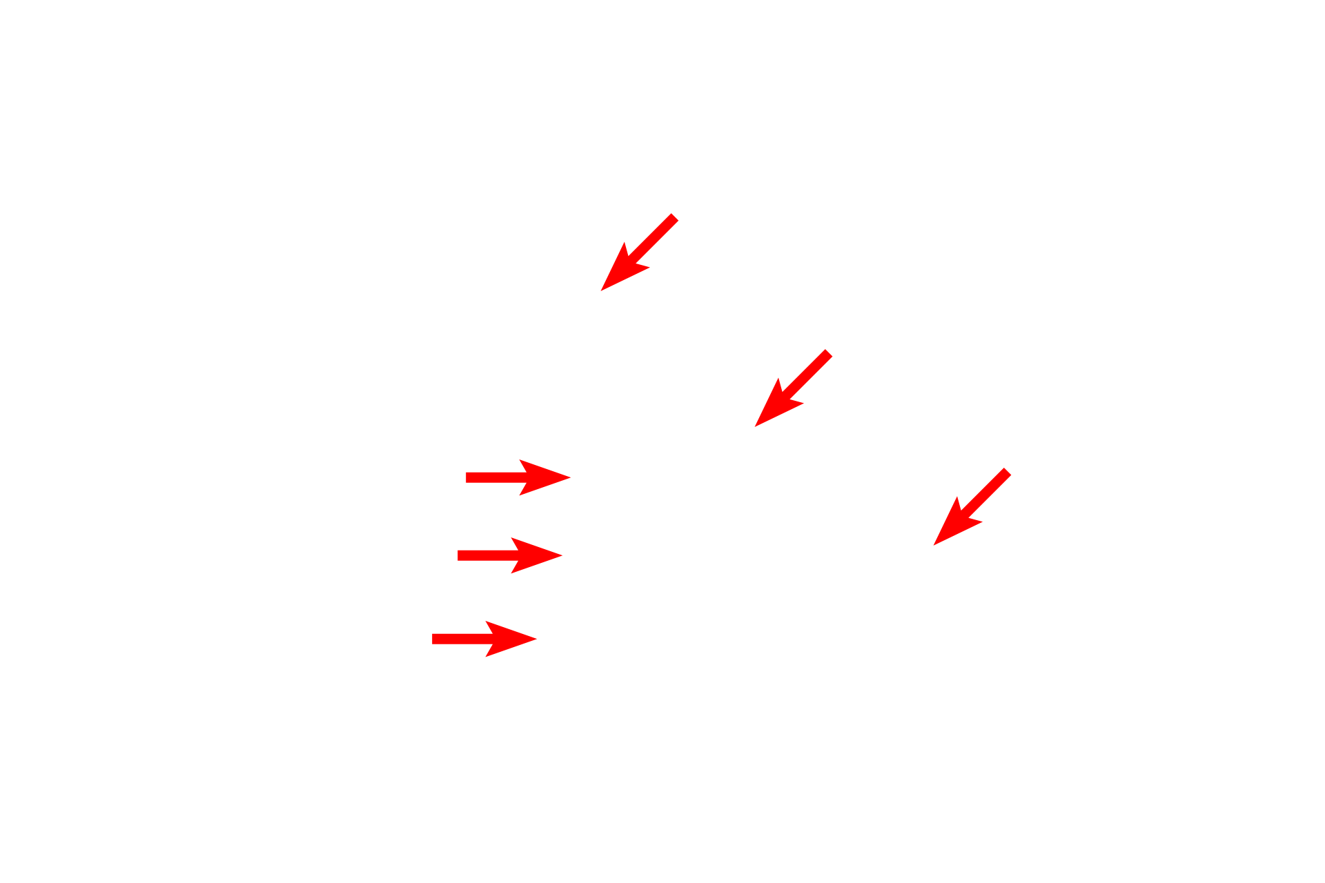 Basal laminae > <p>The thick basal lamina is formed by fusion of the individual podocyte and endothelial cell basal laminae. This layer plays a critical role in the glomerular filtration process as fluid leaves the capillary lumen and enters Bowman’s space.</p>
