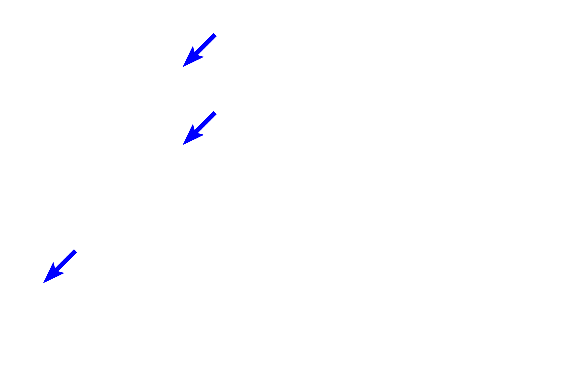  - Intercalated cells <p>Medullary collecting ducts are lined by a columnar epithelium consisting of pale staining principle cells and darker staining intercalated cells, which are much less numerous.  Intercalated cells often bulge into the lumen of the tubule</p>
