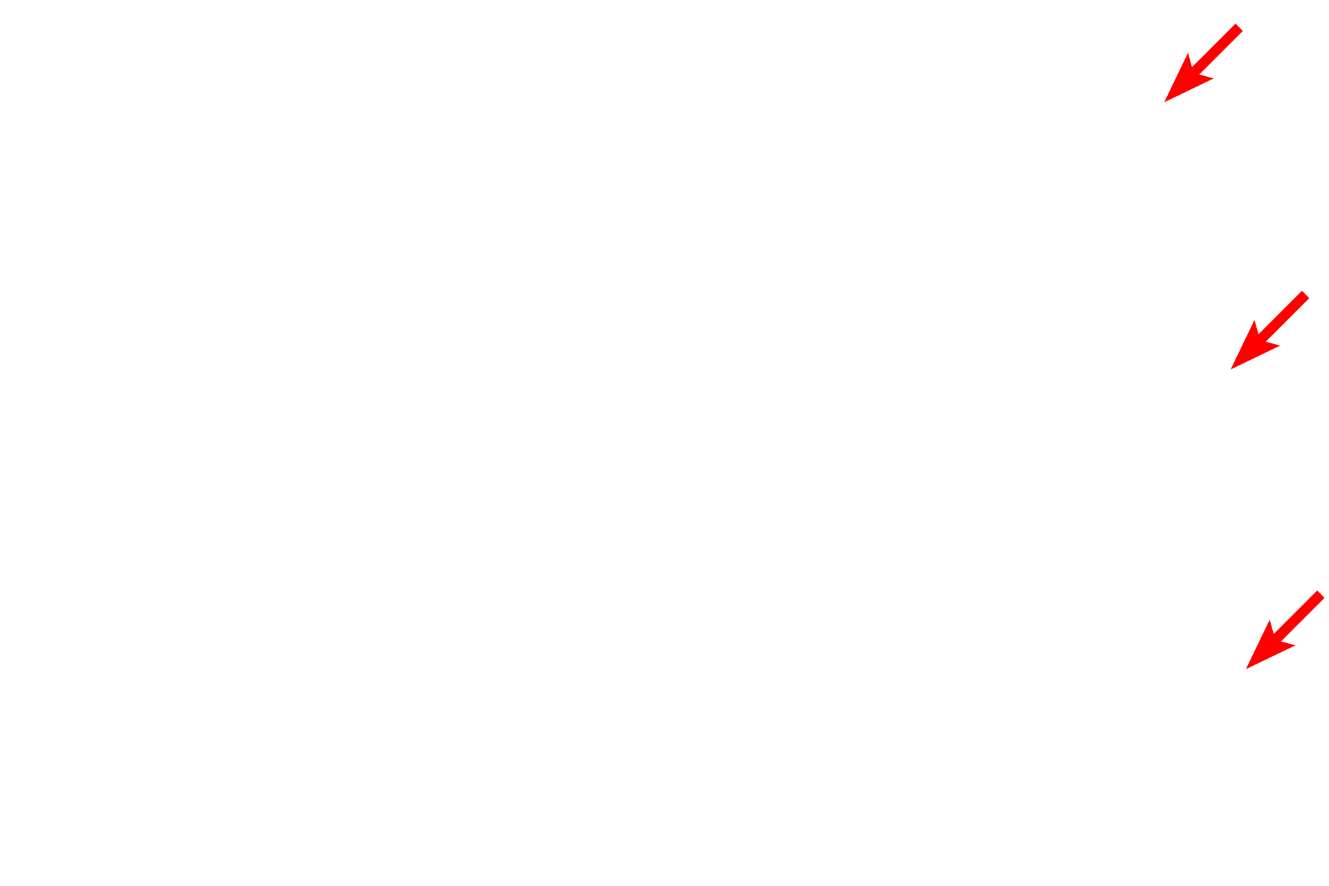 Brush border <p>The epithelial wall of a proximal tubule displays a brush border on the luminal surface and infoldings of the basal plasma membrane on the basal surface.  Tubular invaginations of the clefts between microvilli (apical canaliculi) extend into the cytoplasm.  These canaliculi and poor fixation of the numerous mitochondria result in the foamy appearance of the cells seen at the light microscopic level.  5000x</p>
