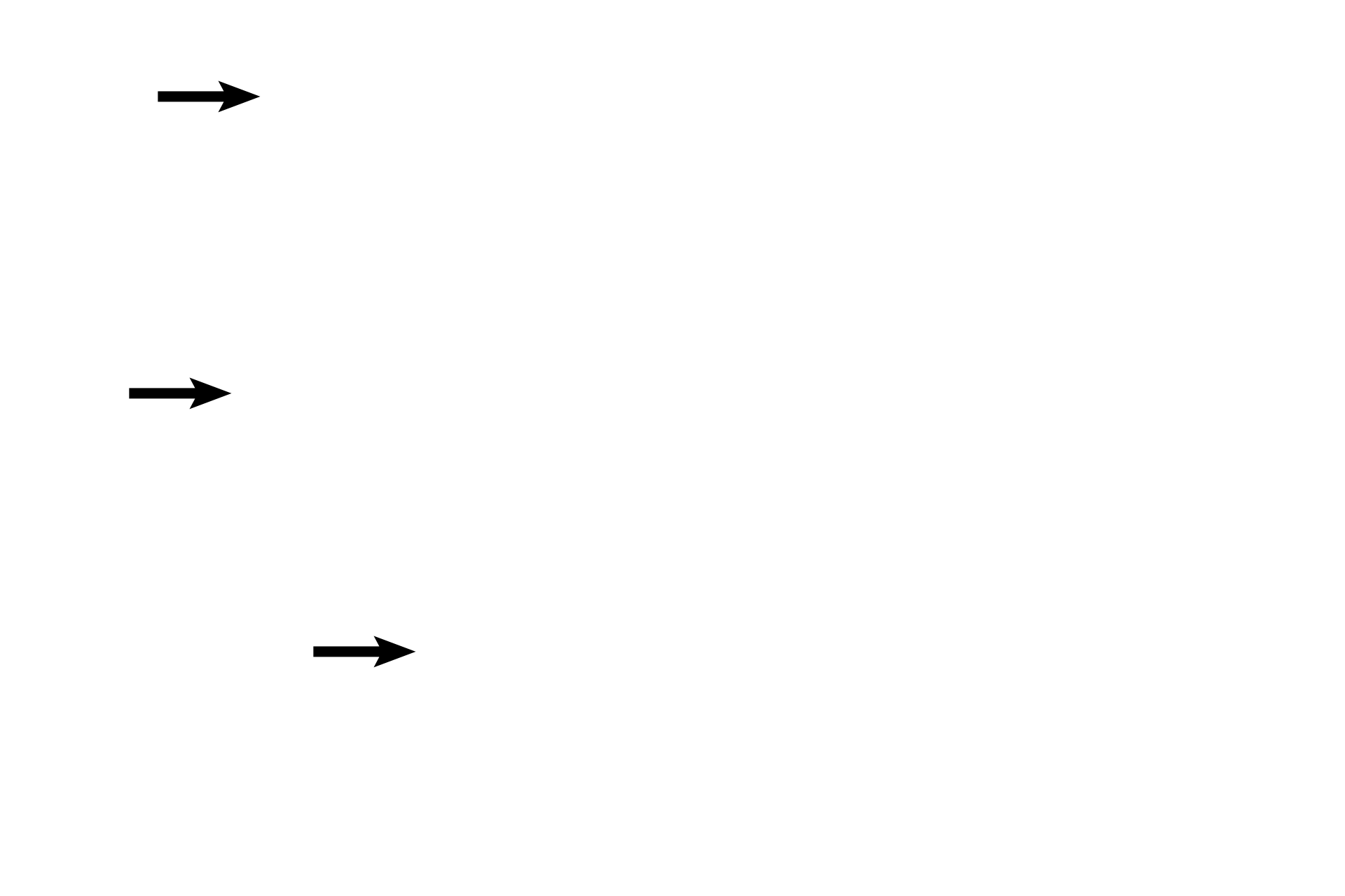 Theca lutein cells <p>A section through the periphery of a corpus luteum shows both types of luteal cells. The larger granulosa lutein cells are frothy, steroid-producing cells that form the bulk of this structure and are located adjacent to the remnant of the antral space.  Theca  lutein cells are smaller, steroid-secreting cells present around the periphery and in the infoldings of the corpus luteum.   100x</p>
