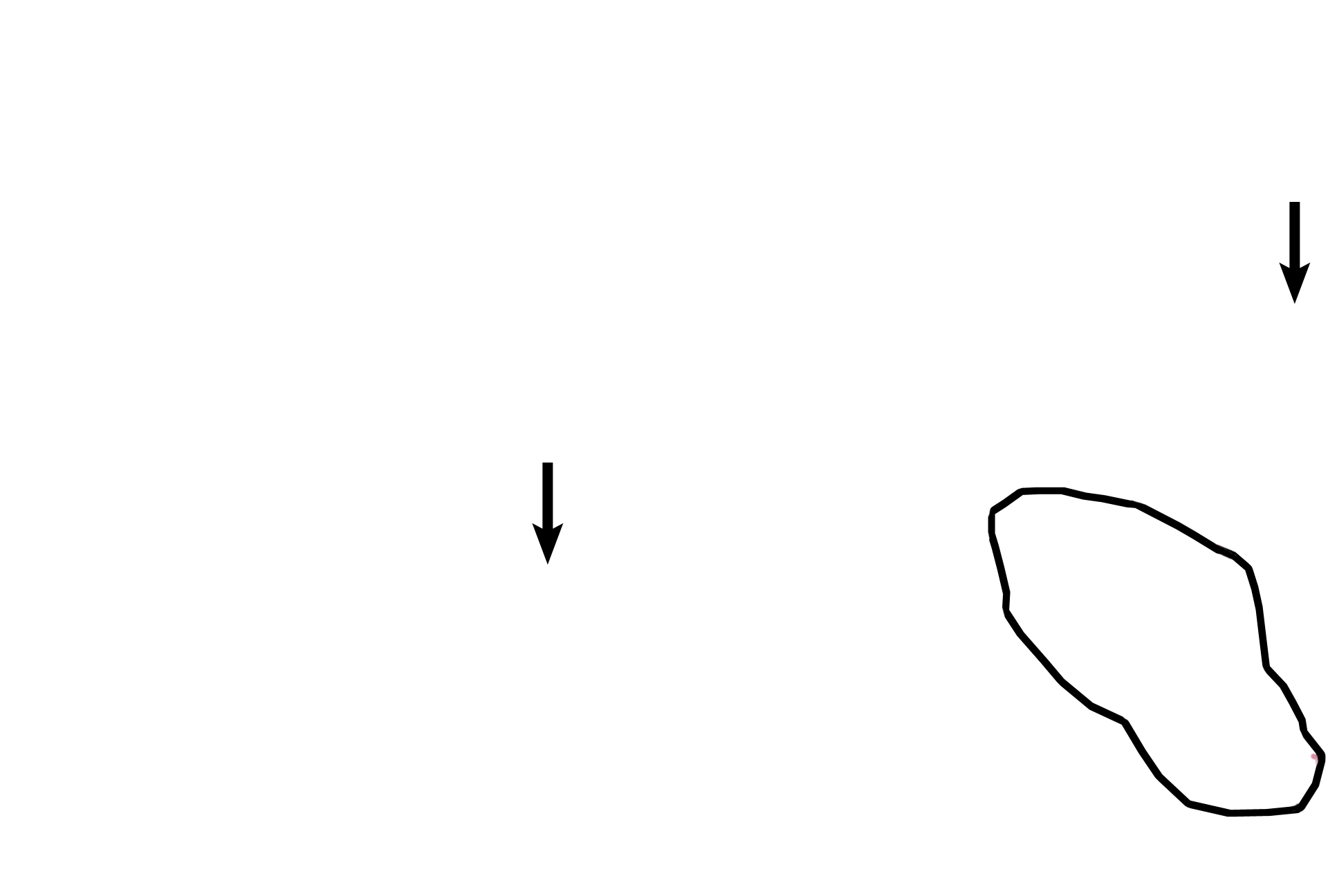  - Fibrinoid <p>Villi appear similar to those in the early placenta except that fetal connective tissue is more condensed; cytotrophoblast cells form a discontinuous layer beneath the syncytiotrophoblast; fibrinoid is seen in villi; and syncytiotrophoblastic nuclei tend to clump.  Fetal capillaries are more numerous and are frequently located immediately beneath the syncytial layer.  400x</p>
