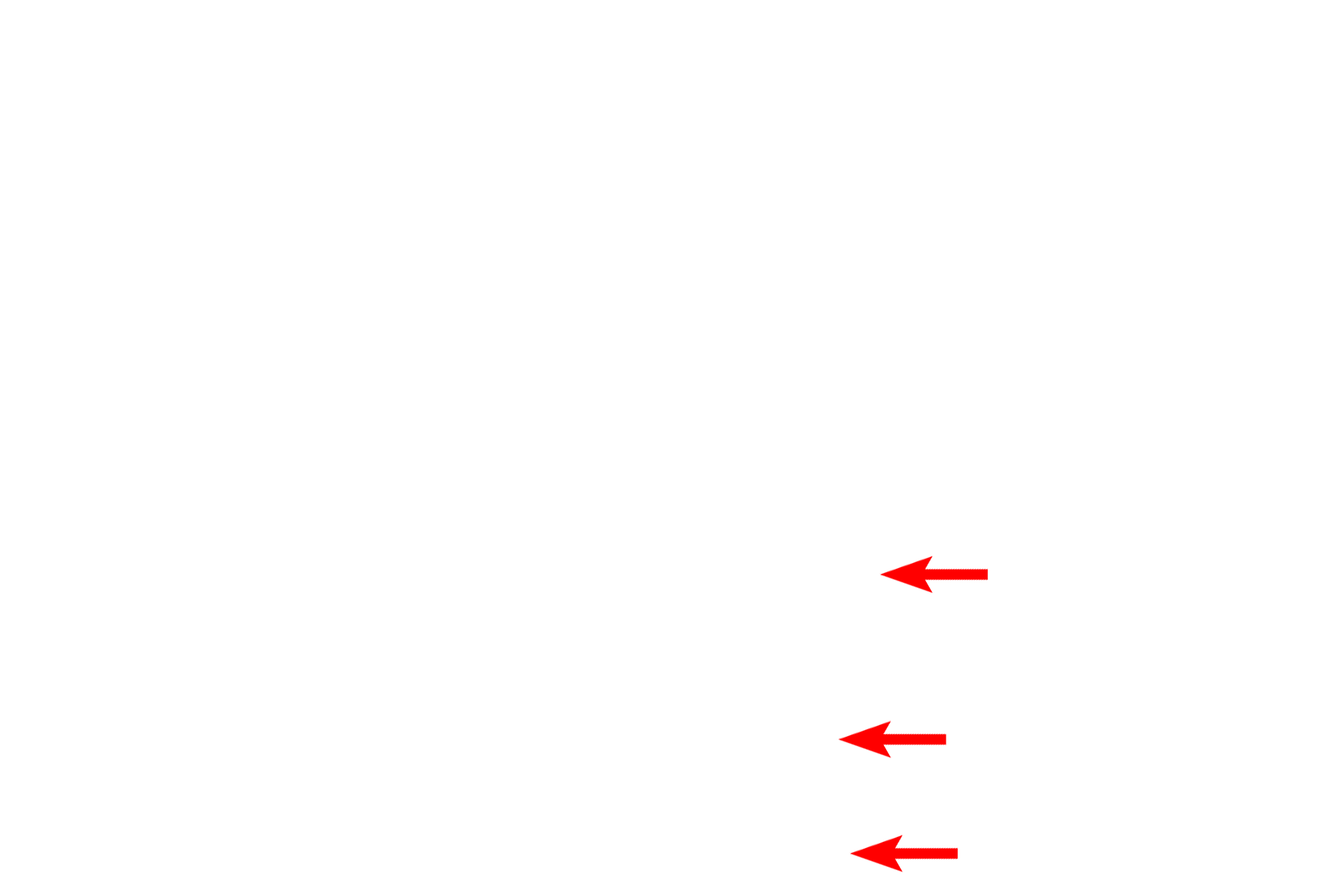 Keratohyalin granules <p>Stratum granulosum cells contain keratohyalin granules of varying sizes. The contents of these electron dense, non-membrane-enclosed granules aggregate tonofibrils into a tightly packed matrix.  Additional components crosslink sub-plasmalemmal proteins producing a thickened, cornified cell envelope.  The resulting non-living scales or squames form the stratum corneum.  10,000x </p>
