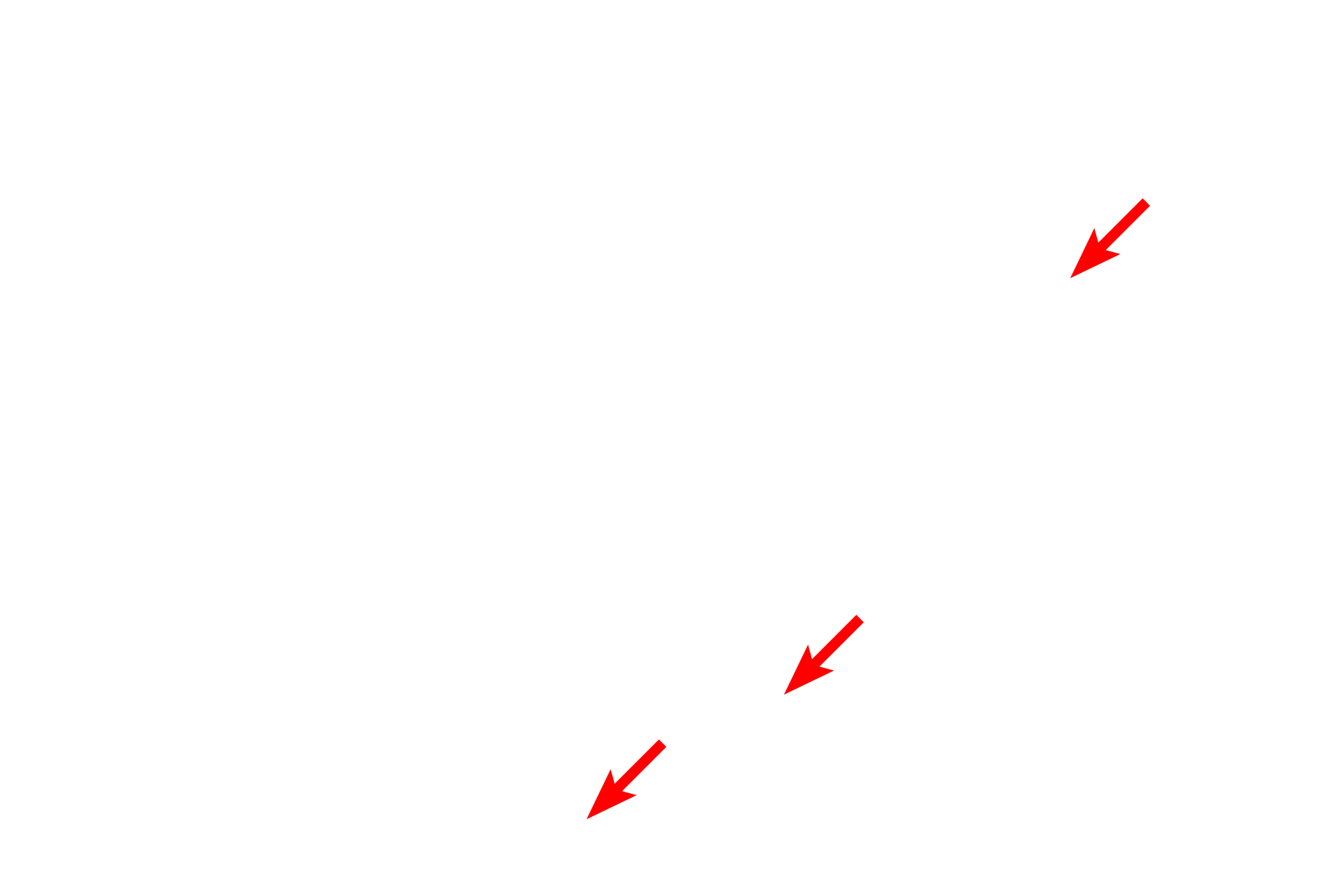 Keratin filaments <p>Stratum granulosum cells contain keratohyalin granules of varying sizes. The contents of these electron dense, non-membrane-enclosed granules aggregate tonofibrils into a tightly packed matrix.  Additional components crosslink sub-plasmalemmal proteins producing a thickened, cornified cell envelope.  The resulting non-living scales or squames form the stratum corneum.  10,000x </p>
