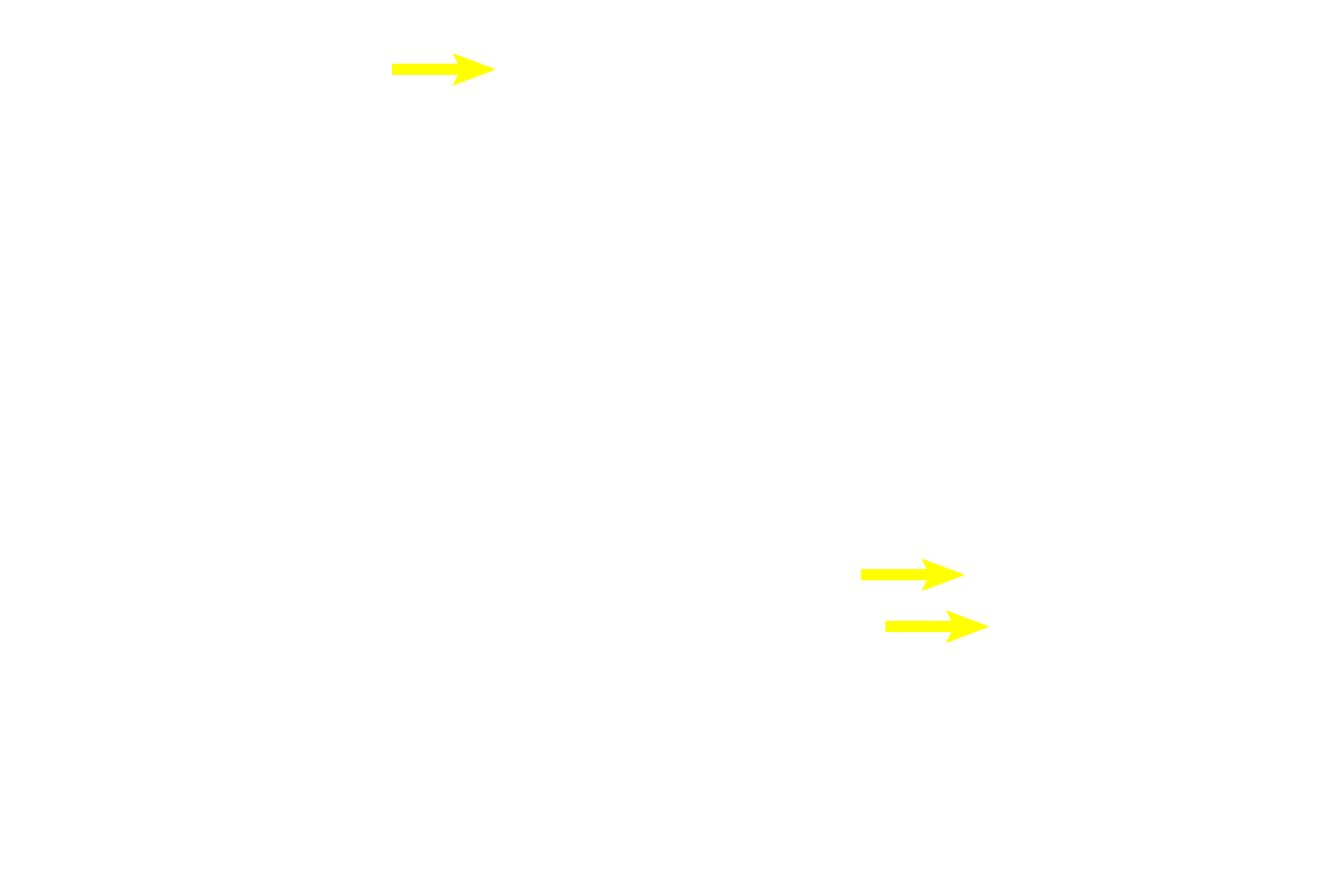 Secretory product <p>Secretory cells of the breast secrete by both the merocrine (protein) and apocrine (lipid) modes of secretion. In the lower right of the field, secretory product is in the process of being released from the cells. The clear regions in the cytoplasm contain lipid. 1000x</p>
