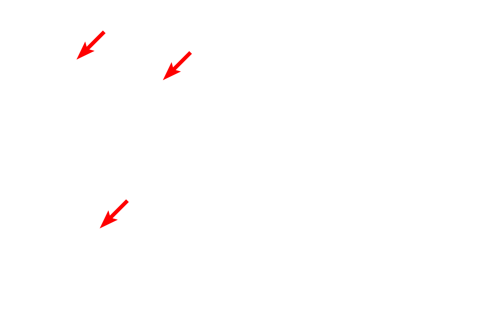 Fibroblast processes <p>This electron micrograph of dense irregular connective tissue shows active fibroblasts surrounded by collagen and elastic fibers. Active fibroblasts have euchromatic nuclei and in this tissue they have thin cell processes. 5000x</p>
