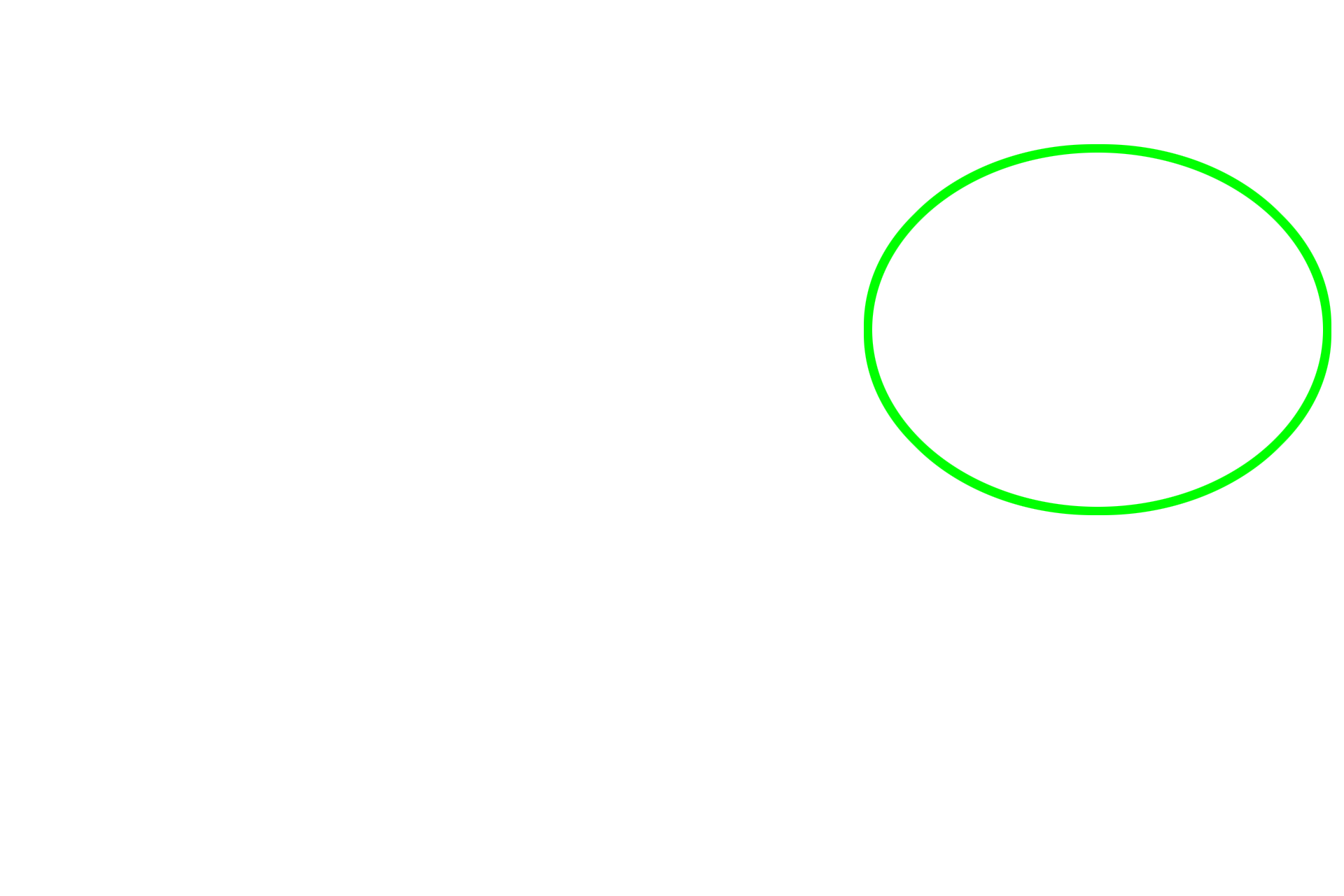 Macrophage > <p>Macrophages phagocytose air-borne particles (dust cells) and/or red blood cells present in alveoli during congestive heart failure (heart failure cells). Macrophages may be located within the wall of the interalveolar septum or may lie free in the alveolar space, lying within the surfactant layer, as seen here. </p>
