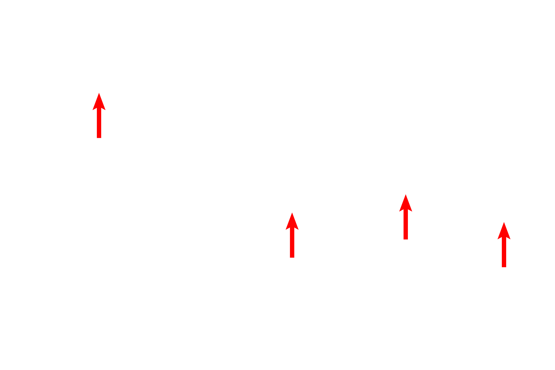  - Connective tissue core <p>This electron micrograph shows many of the components of the interalveolar septum illustrated in the cartoon. The attenuation of type I cell cytoplasm and the protrusion of the capillaries are most evident. Surfactant is not preserved during fixation of lung tissue, and no septal cells nor macrophages are present in this image. 4000x</p>
