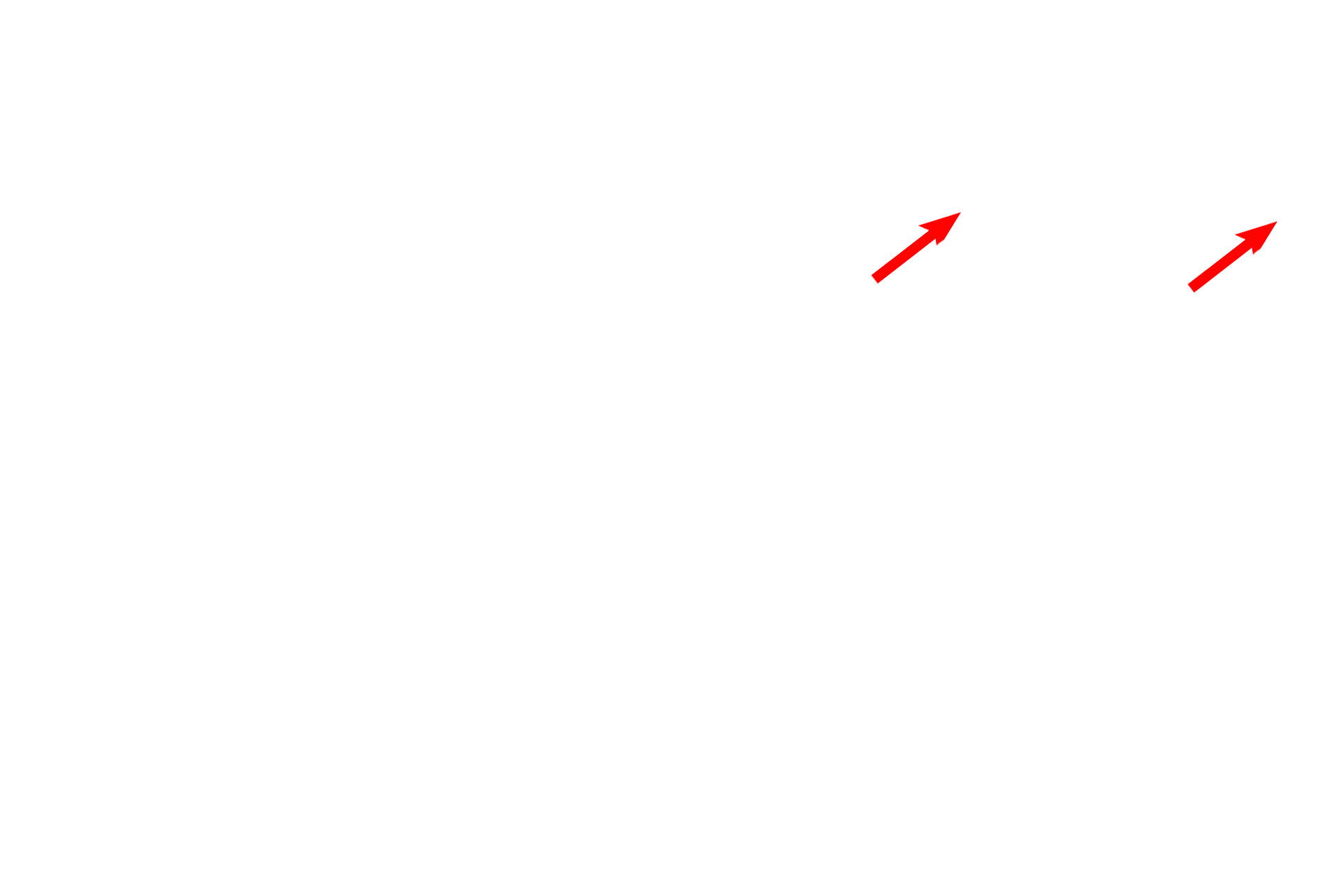  - Blood cells <p>This electron micrograph shows many of the components of the interalveolar septum illustrated in the cartoon. The attenuation of type I cell cytoplasm and the protrusion of the capillaries are most evident. Surfactant is not preserved during fixation of lung tissue, and no septal cells nor macrophages are present in this image. 4000x</p>
