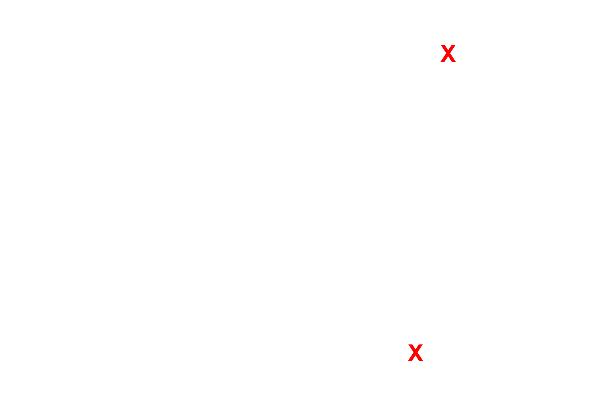 Alveoli <p>The attenuated cytoplasm of the type I cells lines the interalveolar septum. Septal cells can be identified readily by their vacuoles containing the precursor proteins for surfactant. An alveolar macrophage, lying in in the surfactant layer of the alveolar lumen, is filled with phagocytosed material. 5000x</p>
