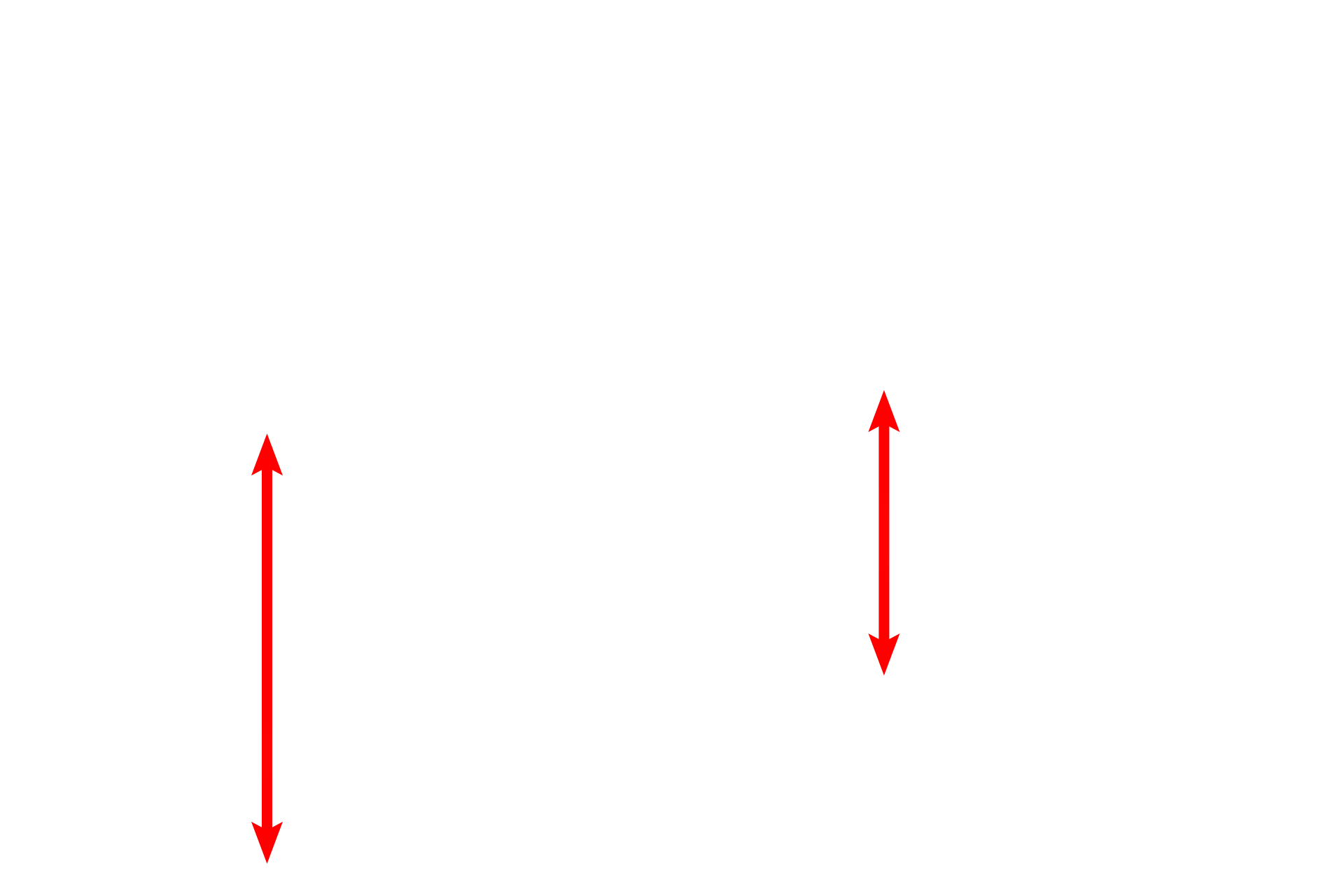Interalveolar septum <p>The attenuated cytoplasm of the type I cells lines the interalveolar septum. Septal cells can be identified readily by their vacuoles containing the precursor proteins for surfactant. An alveolar macrophage, lying in in the surfactant layer of the alveolar lumen, is filled with phagocytosed material. 5000x</p>
