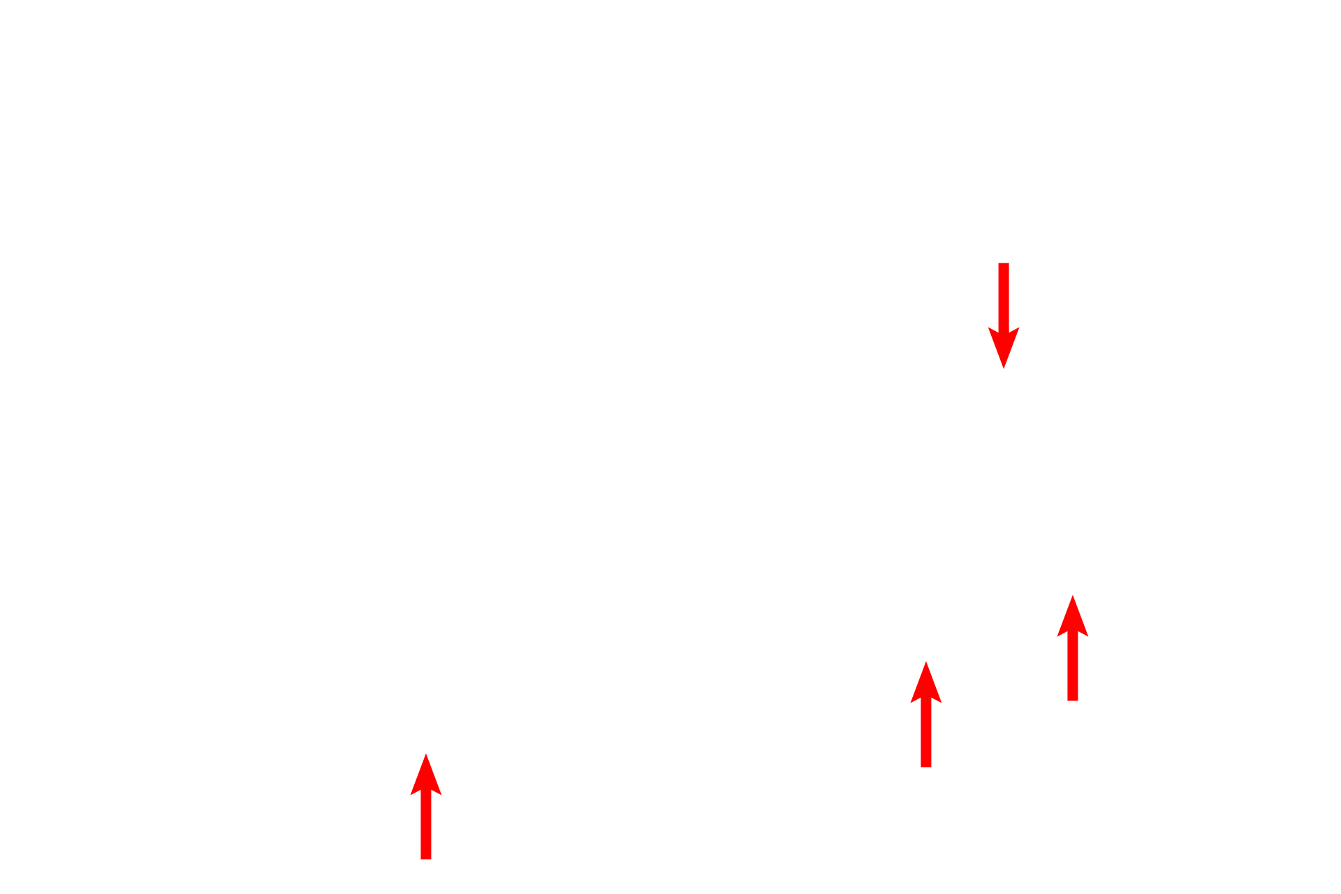  - Type I cells <p>The attenuated cytoplasm of the type I cells lines the interalveolar septum. Septal cells can be identified readily by their vacuoles containing the precursor proteins for surfactant. An alveolar macrophage, lying in in the surfactant layer of the alveolar lumen, is filled with phagocytosed material. 5000x</p>
