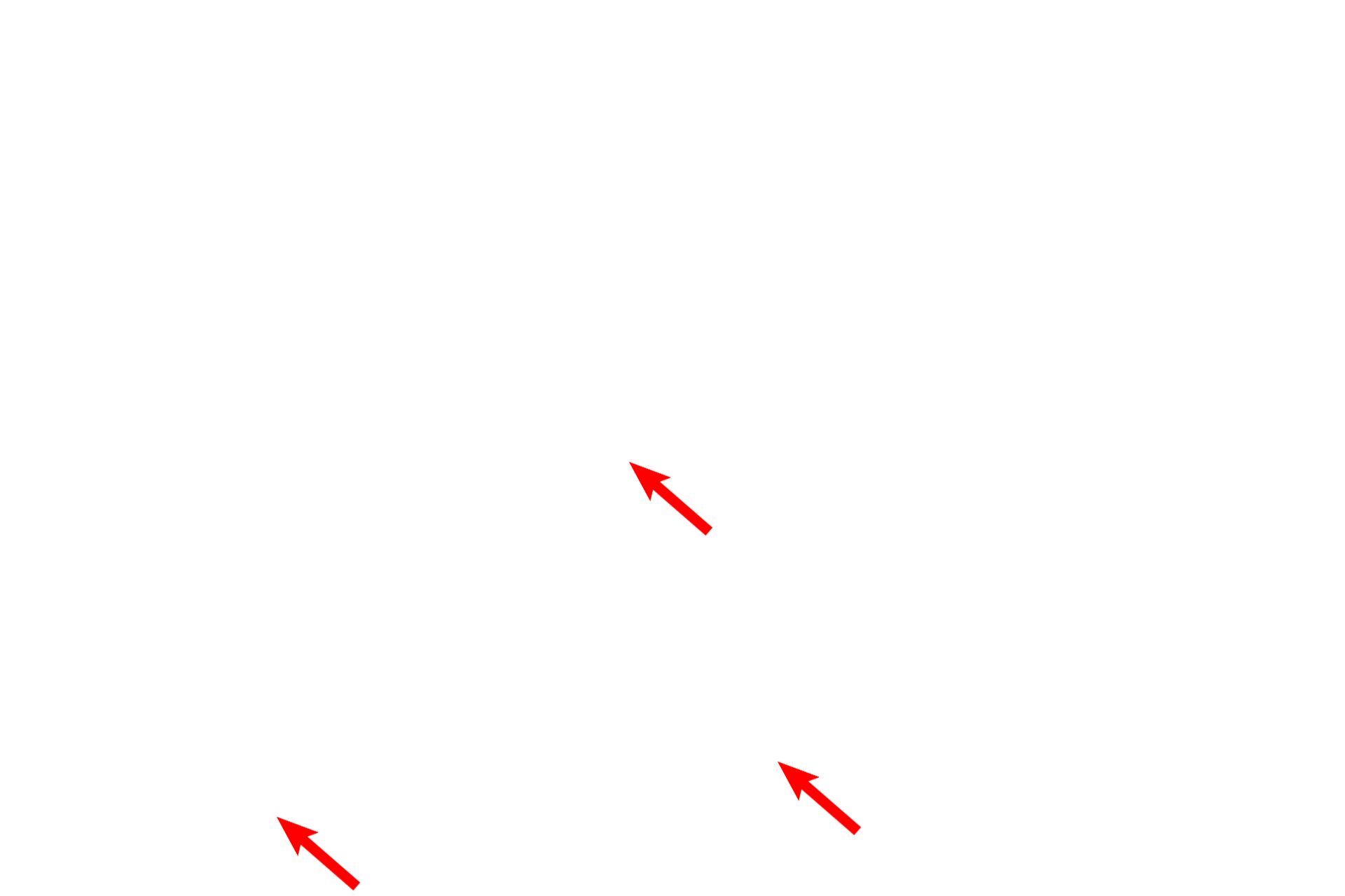  - Type II cells <p>The attenuated cytoplasm of the type I cells lines the interalveolar septum. Septal cells can be identified readily by their vacuoles containing the precursor proteins for surfactant. An alveolar macrophage, lying in in the surfactant layer of the alveolar lumen, is filled with phagocytosed material. 5000x</p>
