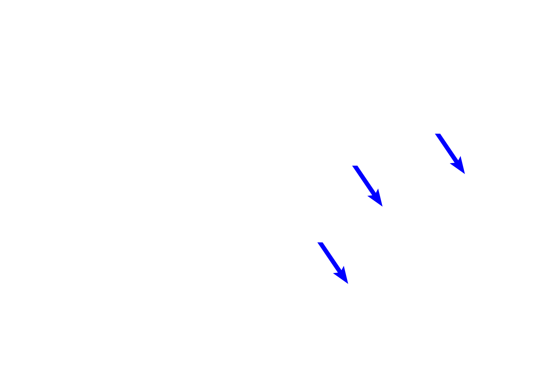 Macrophages > <p>Macrophages, filled with black carbon particles, are seen scattered in the connective tissue surrounding the bronchioles. Such macrophages are called “dust cells.”</p>
