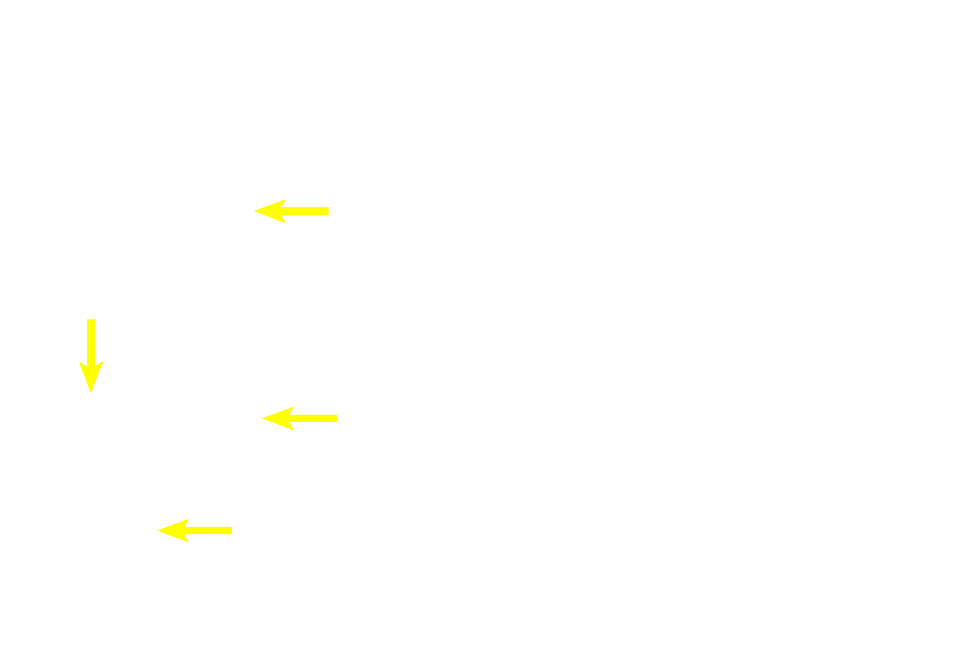 New lamellae > <p>Lamellar deposition has begun around the periphery of several spaces, which were created by death of chondrocytes during endochondral ossification. Continued deposition will create osteons, converting this spongy woven bone to the compact bone seen in the center of the image on the right.</p>
