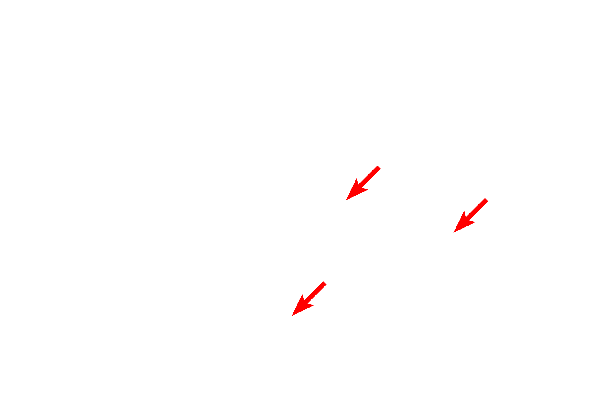  - Mast cell granules <p>This electron micrograph shows two macrophages with indented nuclei and ruffled plasma membranes. The mast cell seen here contains numerous electron-dense, secretory granules throughout its cytoplasm. Its spherical, central nucleus shows moderate, peripheral heterochromatin. 7000x</p>
