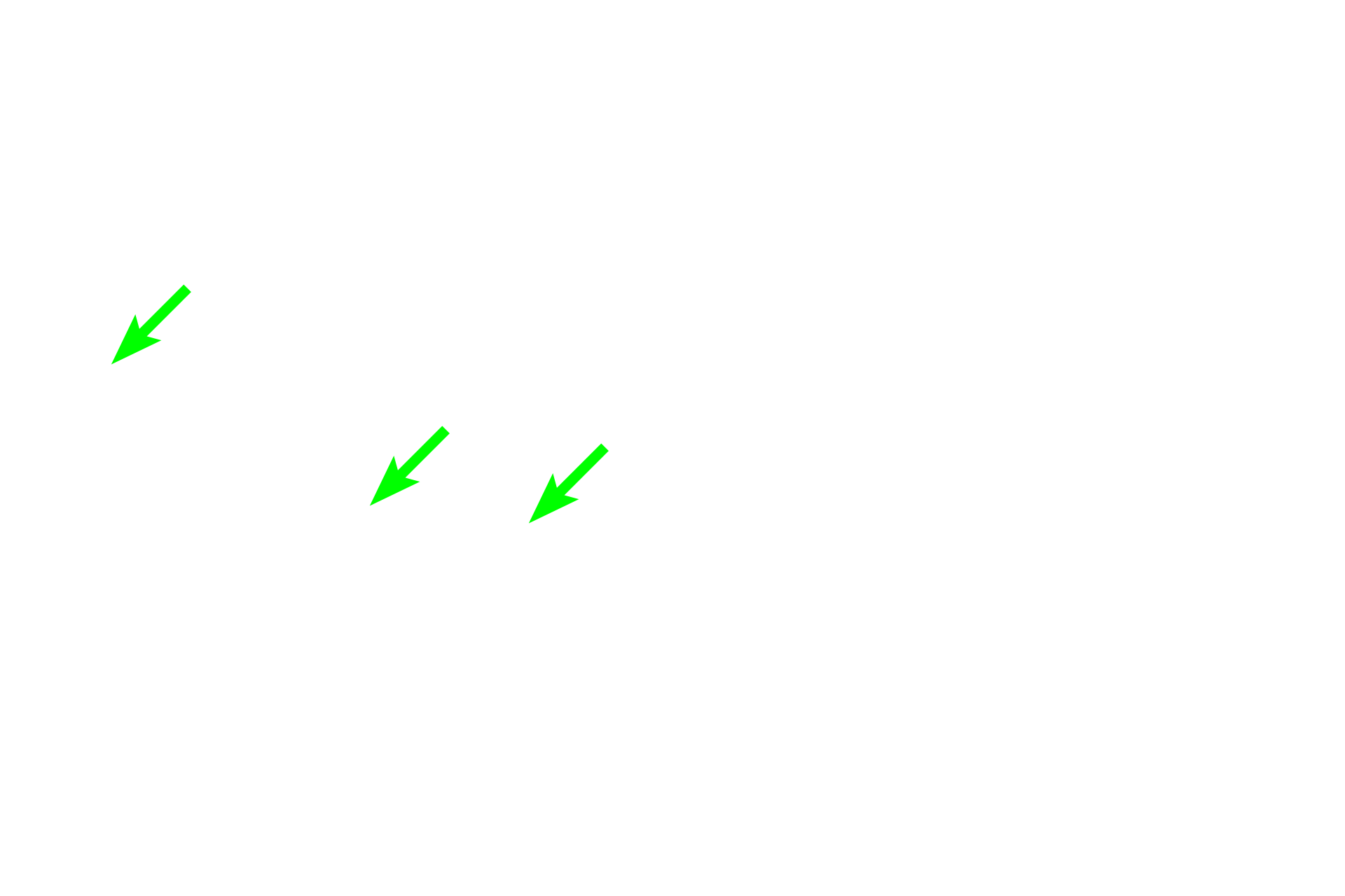  - Plasma cells <p>An accumulation of plasma cells demonstrates two diagnostic features that help identify plasma cells. Heterochromatin frequently clumps around the periphery of the nucleus, forming a “clock face” appearance. Additionally, a pale-staining region in the cytoplasm adjacent to the nucleus indicates the position of the large Golgi apparatus. This region, referred to as a “negative Golgi” image, is surrounded by the more chromophilic, blue-staining, rough endoplasmic reticulum.</p>
