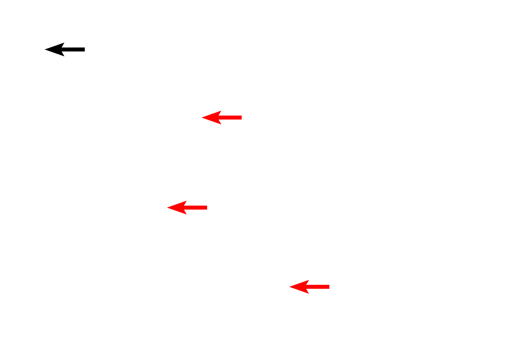 Clockface chromatin <p>Plasma cells have distinctive features that are clearly seen in this electron micrograph: a prominent Golgi; well developed rough endoplasmic reticulum; and a nucleus with large clumps of heterochromatin at the margin of the nucleus (clock-face nucleus). Compare these features with the high magnification light microscopic inset. Plasma cells are derived from B lymphocytes and produce antibodies. 8,000x</p>
