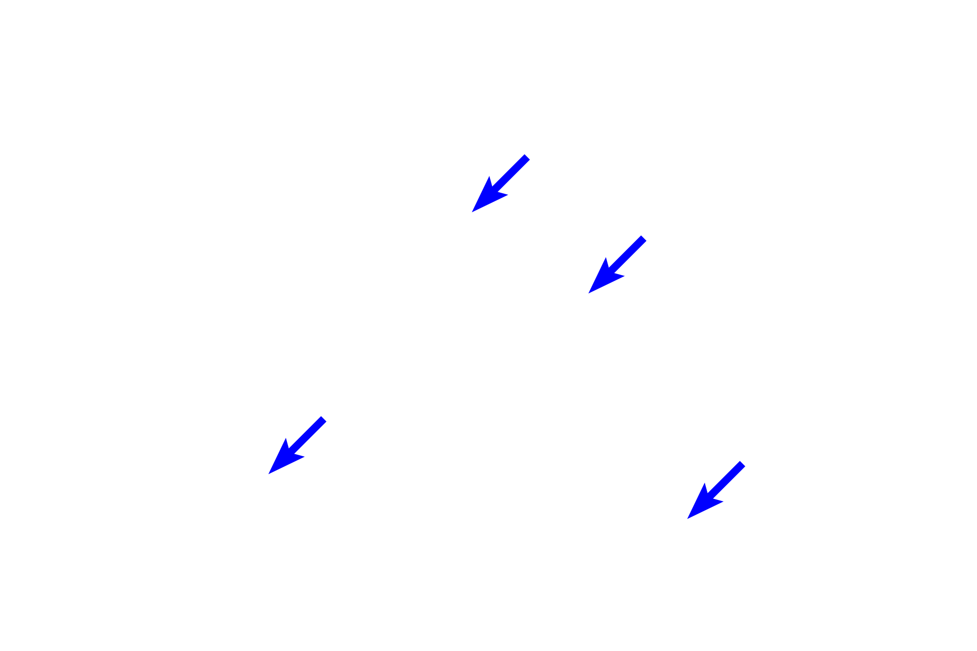 Collagen fibers (xs) <p>Dense irregular connective tissue has irregularly arranged, thick, interwoven collagen bundles and fibers.  The fibroblasts are mostly inactive and have little cytoplasm.  Dense connective tissue contains fewer cells and less ground substance than does loose connective tissue.  Dense irregular connective tissue is found in areas where multidirectional strength is needed.  400x </p>
