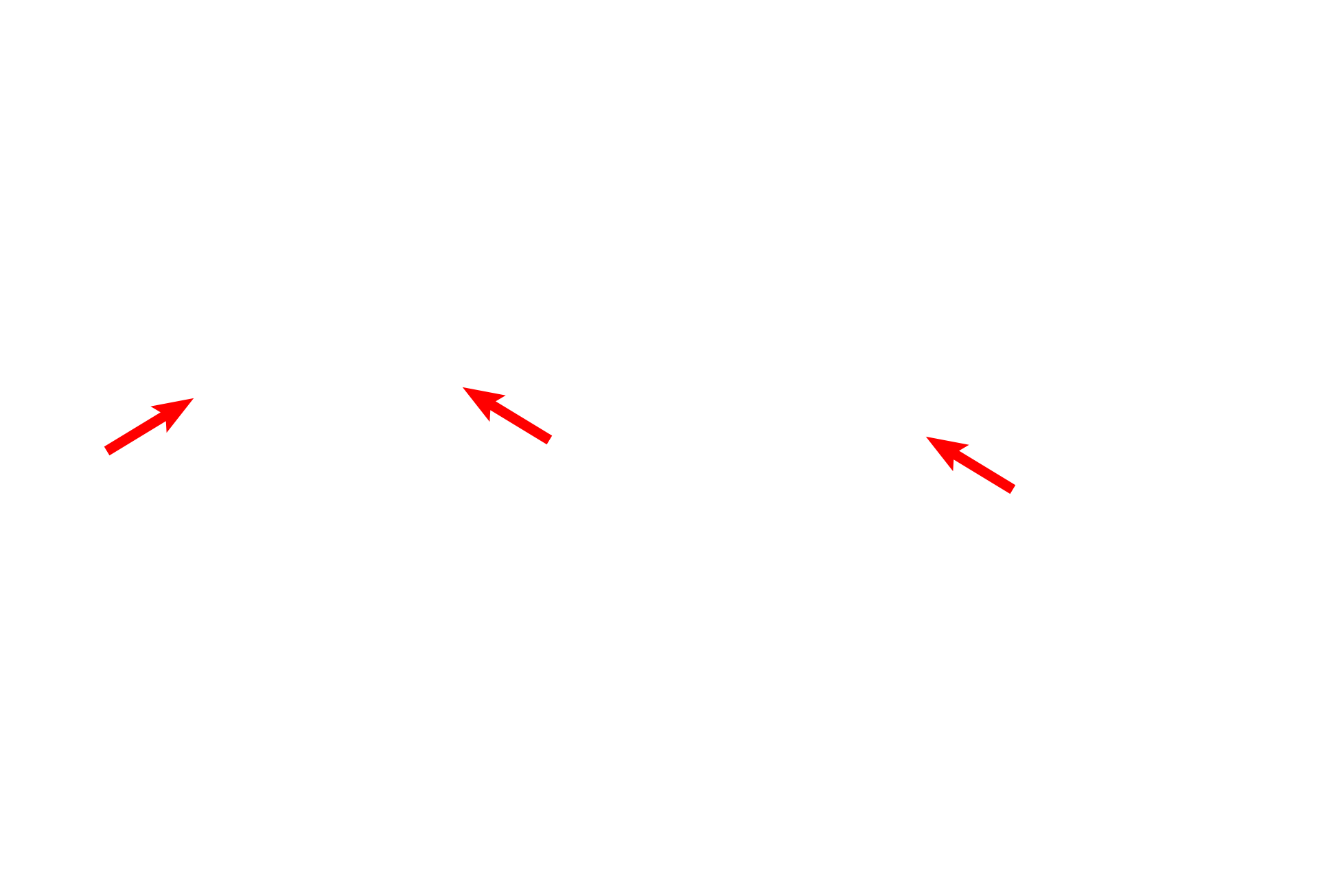 Vestibule > <p>The vestibule is the central portion of the osseous labyrinth. The vestibule is a large chamber that is continuous with and attached to both the cochlea and the semicircular canals. The portions of the membranous labyrinth housed within the vestibule are the utricle and saccule, each containing a macula, the receptor for linear acceleration and gravity.</p>
