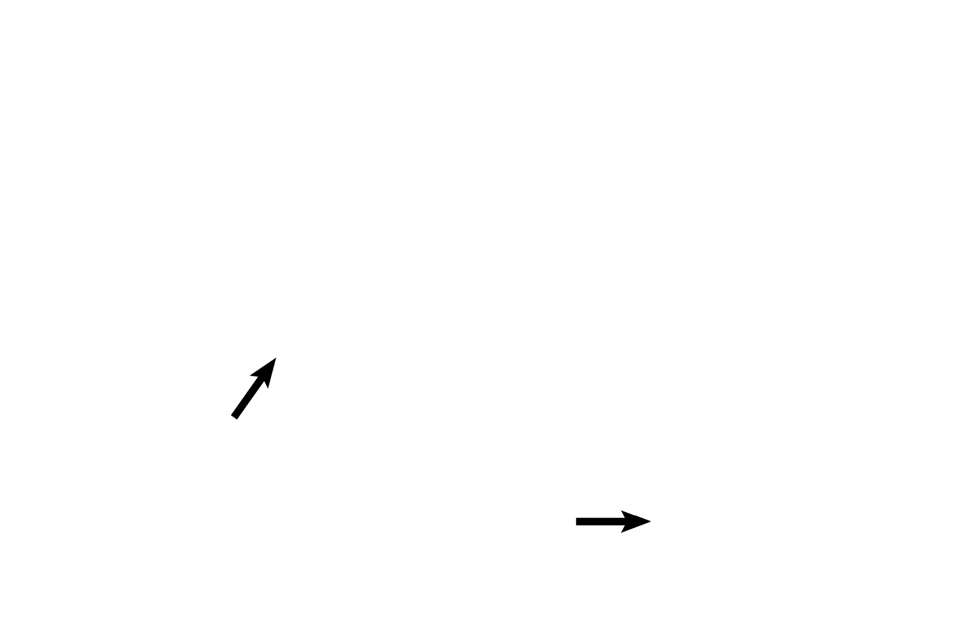  -- Macula of utricle  <p>This section cuts through the utricle in two locations. A thickening in the epithelial lining of the utricle forms the macula, a neuroepithelial receptor, that responds to linear acceleration and gravitational forces, thereby initiating a nerve impulse in CN VIII.</p>
