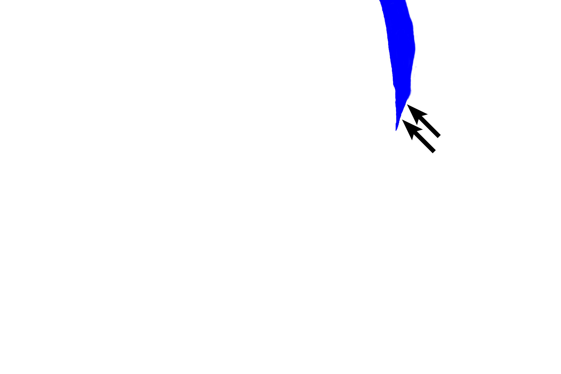 Attachment epithelium > <p>The attachment or junctional epithelium attaches to the tooth enamel.  In older individuals with gingival regression, the junctional epithelium may also contact the cementum.  </p>

