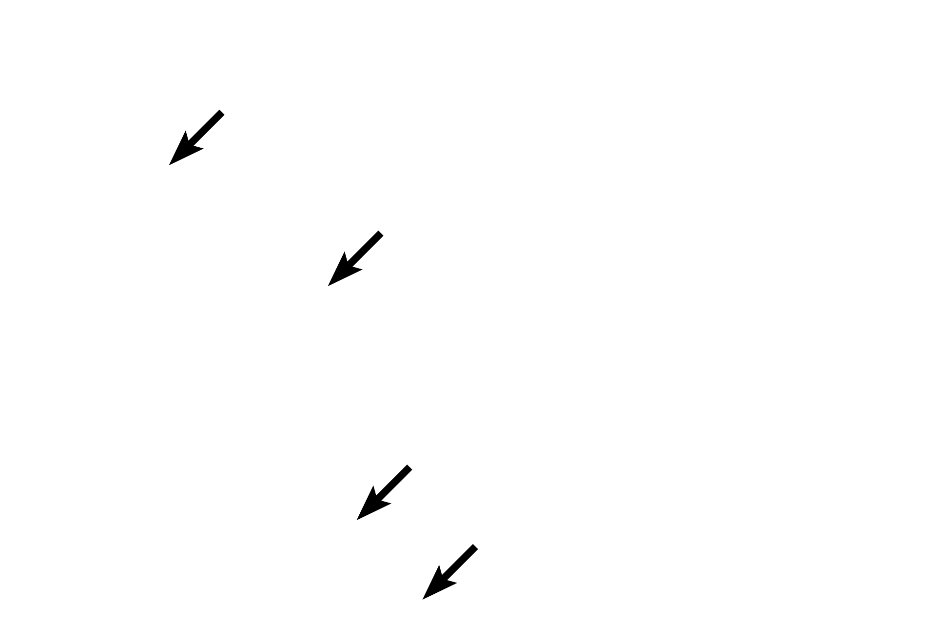 Lymphatic capillaries <p>Diffuse lymphoid tissue, as well as solitary and aggregated lymphoid nodules in the lamina propria, filter tissue fluid that eventually passes into lymphatic capillaries as lymph. Lymph capillaries are the blind-ended beginnings of a complex network of vessels that eventually drain through lymph nodes and into the blood vascular system. Lymph contains high levels of protein and thus the lumen of lymphatic vessels often stains pink with eosin. Esophagus 200x</p>
